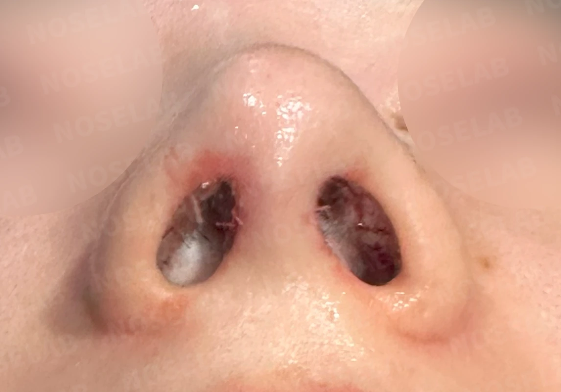 퍼진 코와 복코를 함께 교정하는 방법 — 수술 직후 0일 콧구멍사진입니다. 직후 사진은 부기가 있는 상태로 최종 결과와 다를 수 있습니다.