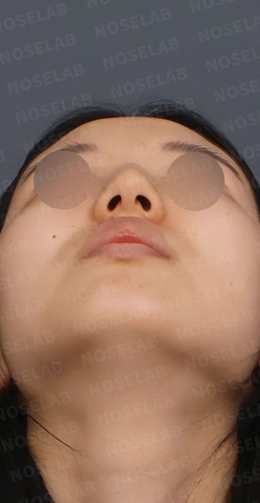 매부리코와 긴코 교정, 자가늑연골로 오똑한 코끝과 코막힘까지 해결 — 디자인 상담 우측 측면, 비스듬한 측면, 비공 사진입니다.