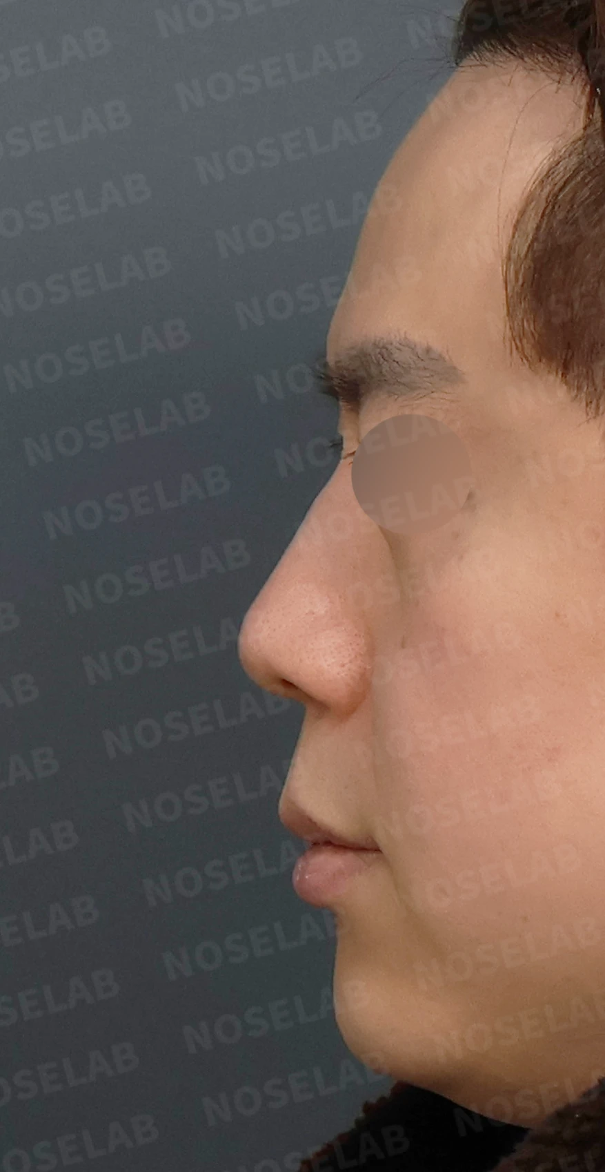 휘어진 매부리코, 자가늑연골로 교정한 남자 코성형 사례 — 디자인 상담 정면, 좌측 측면, 비스듬한 측면 입니다.