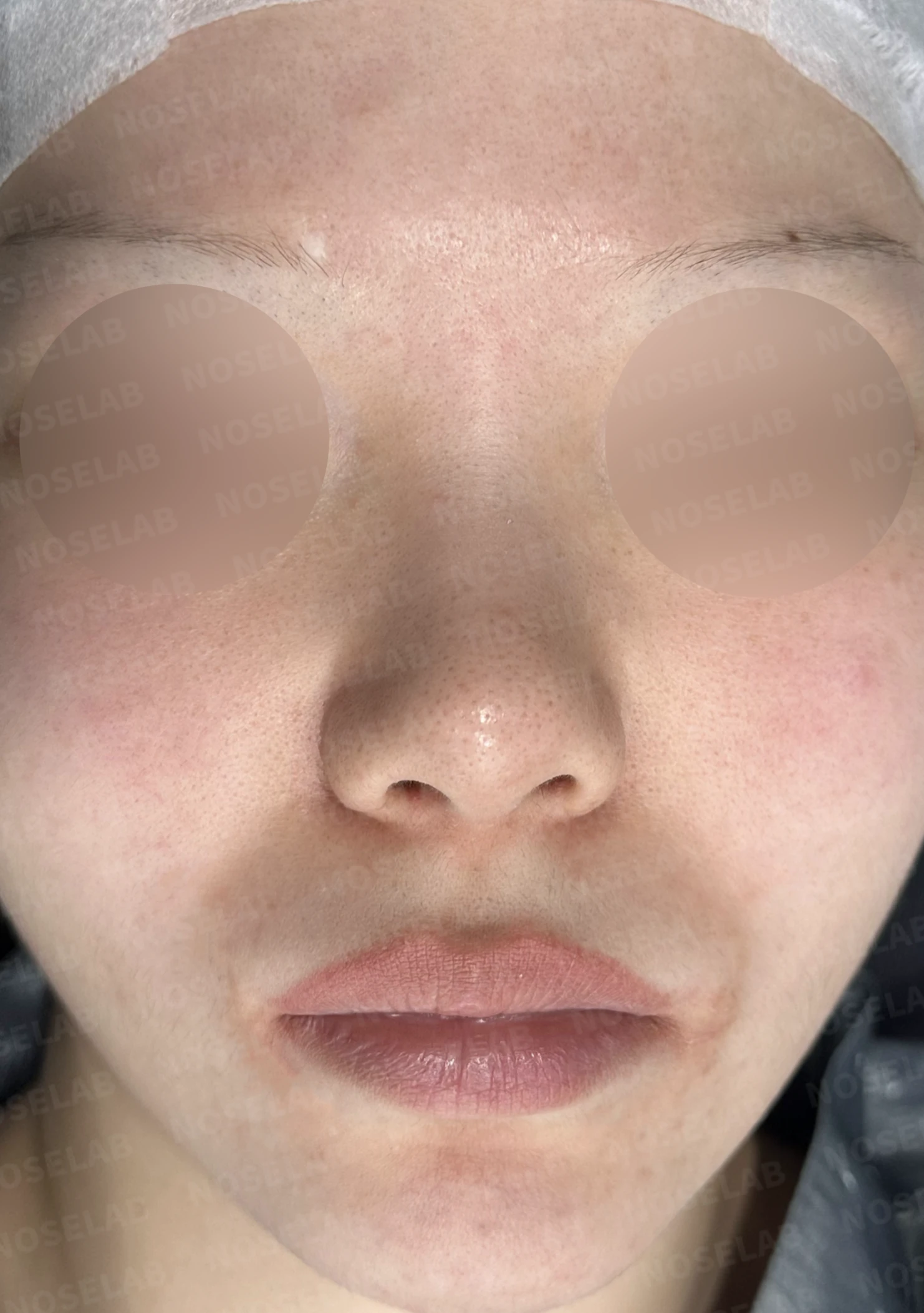 복코와 들린 코끝, 자가늑연골로 여성스러운 직반라인 완성 — 전(좌) 직후(후)