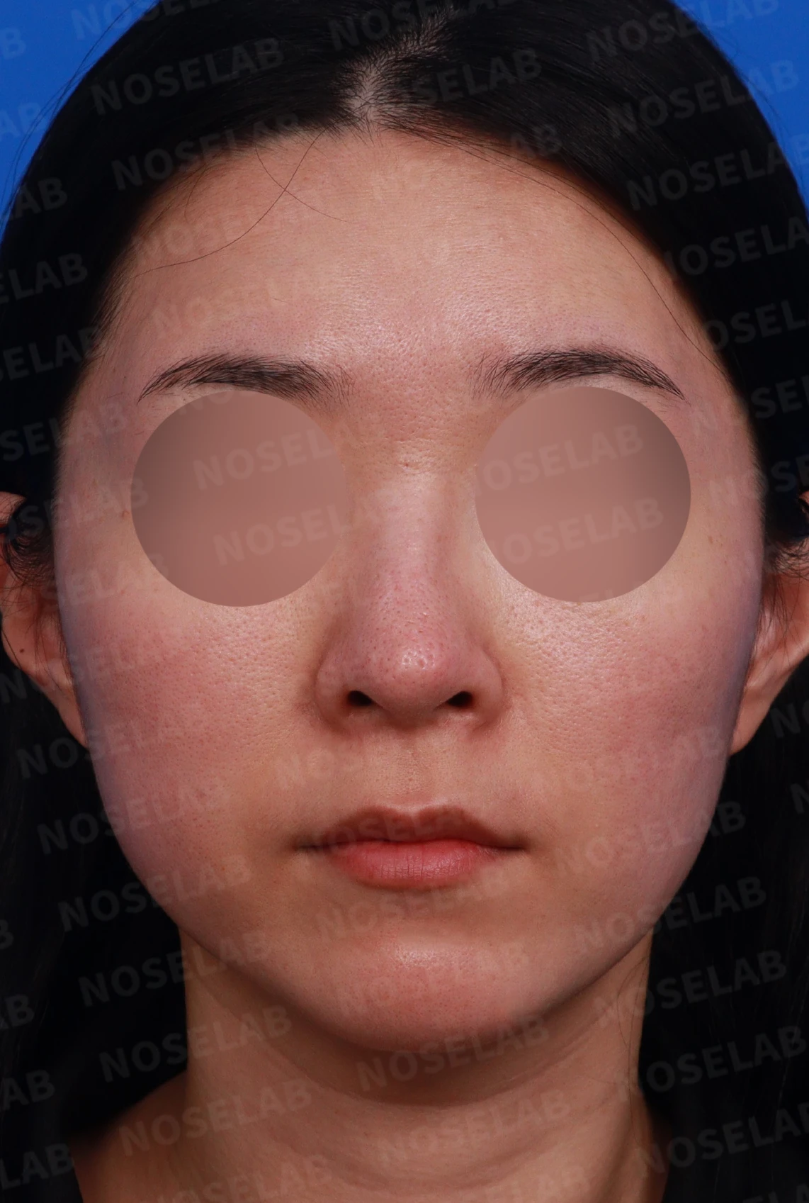 외측절골 후 코막힘과 비대칭을 살펴보는 교정 방법 — 디자인 상담 정면, 좌측 측면, 비스듬한 측면 사진