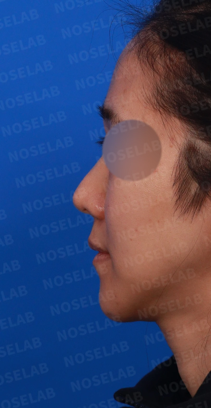 비중격 연골이 약해진 코, 보형물 없이 재건하는 방법 — 디자인 상담 정면, 좌측 측면, 비스듬한 측면 사진