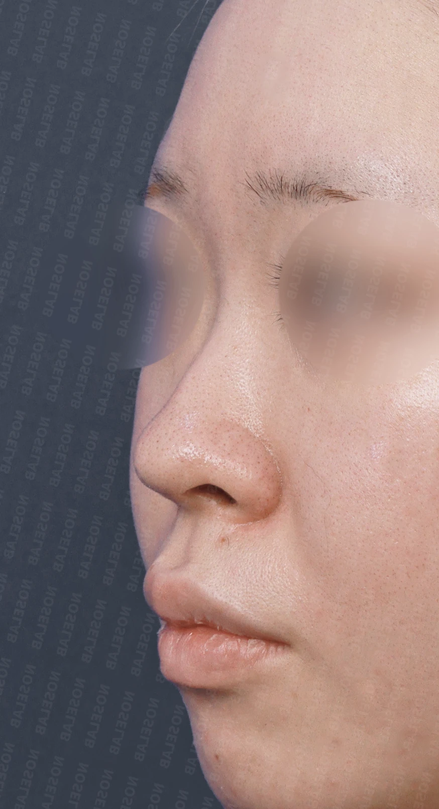 퍼진코, 복코 교정으로 균형 잡힌 이미지 완성 — 전(좌) 직후(우)