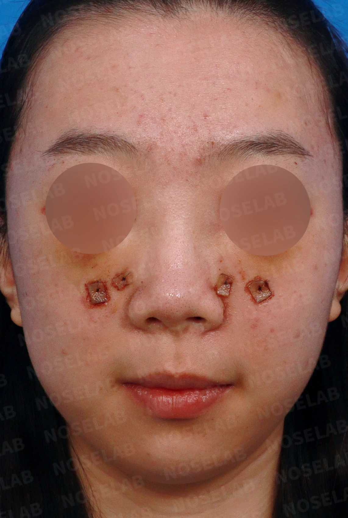 메드포어로 손상된 비중격, 자가늑연골로 완벽하게 재건하다 — 디자인 상담 정면, 좌측 측면, 비스듬한 측면 사진입니다.