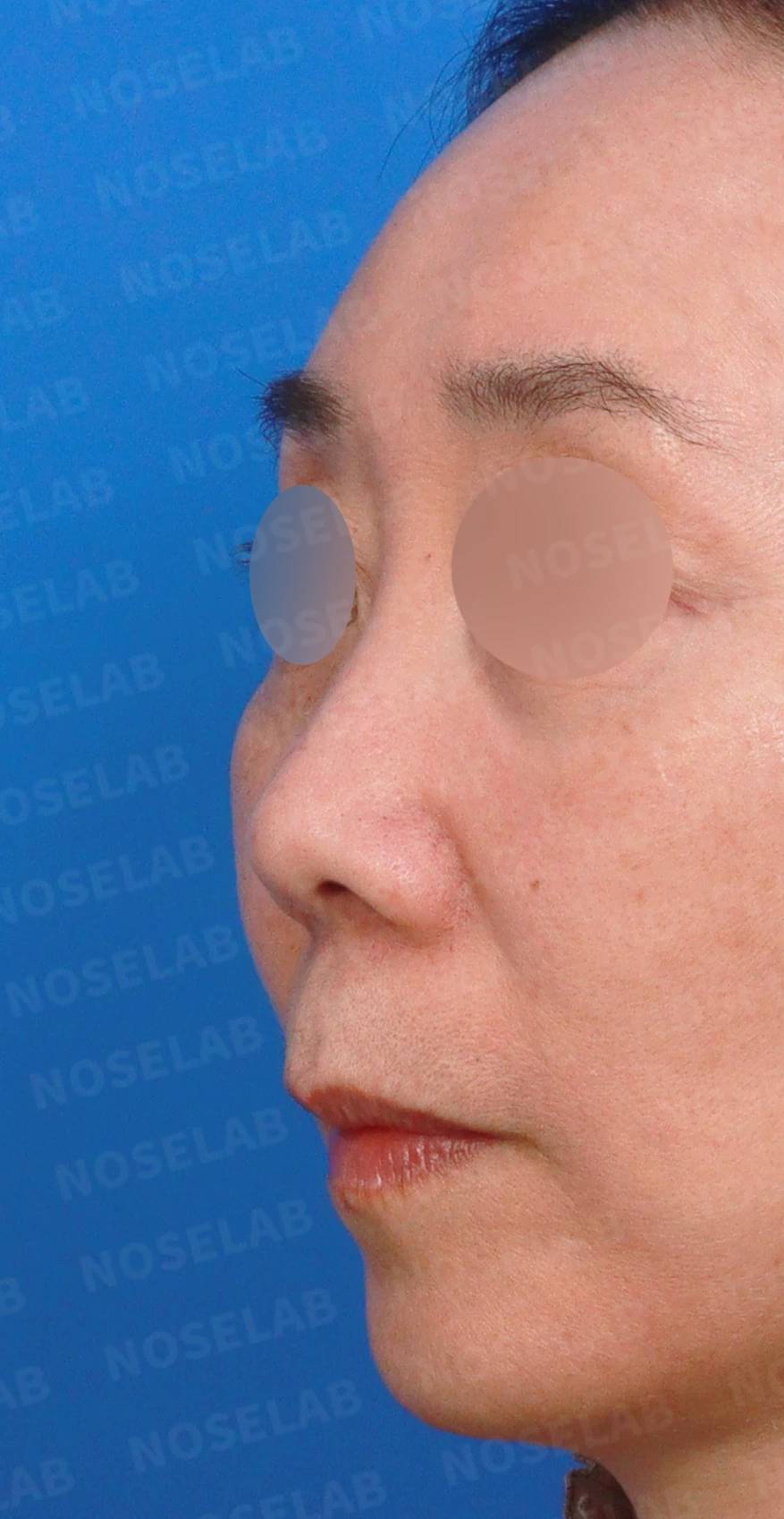 정면에서 콧구멍이 한쪽만 더 보이는 이유와 코끝 재건 방법 — 디자인 상담 정면, 좌측 측면, 비스듬한 측면 사진입니다.
