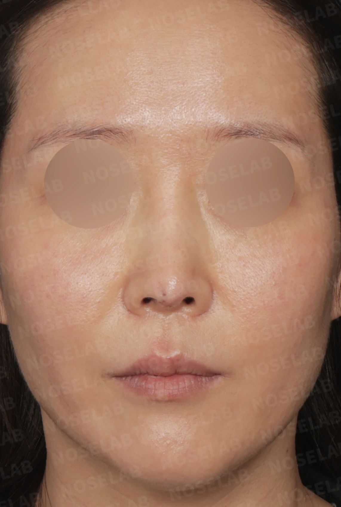 코끝 피부 함몰과 보형물 비침, 자가늑연골로 안전하게 복원한 코재수술 — 디자인 상담 — 정면, 좌측 측면, 비스듬한 측면