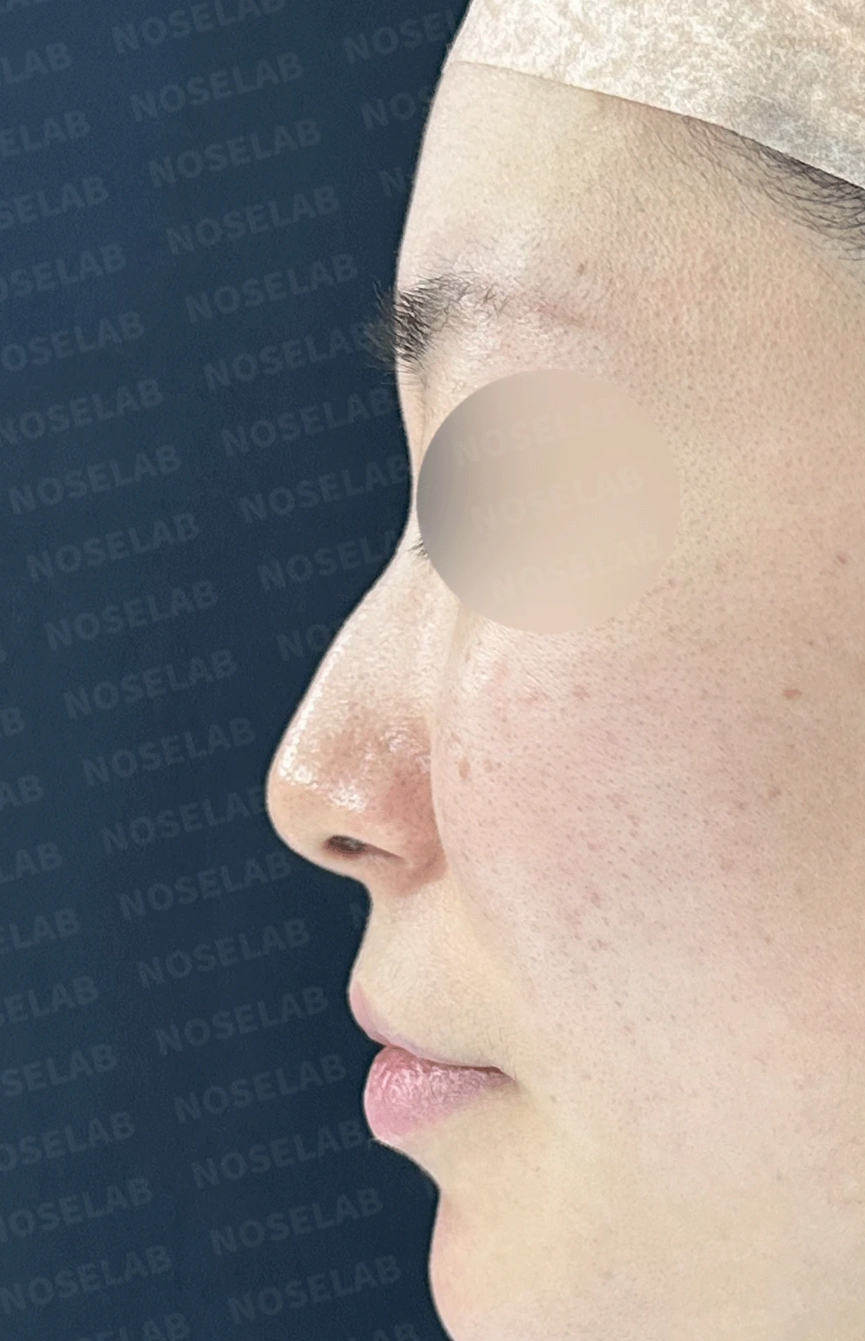매부리코와 휜 코에 코막힘이 함께 오는 이유, 복합 교정은 어떻게 하나 — 본문 사진 9