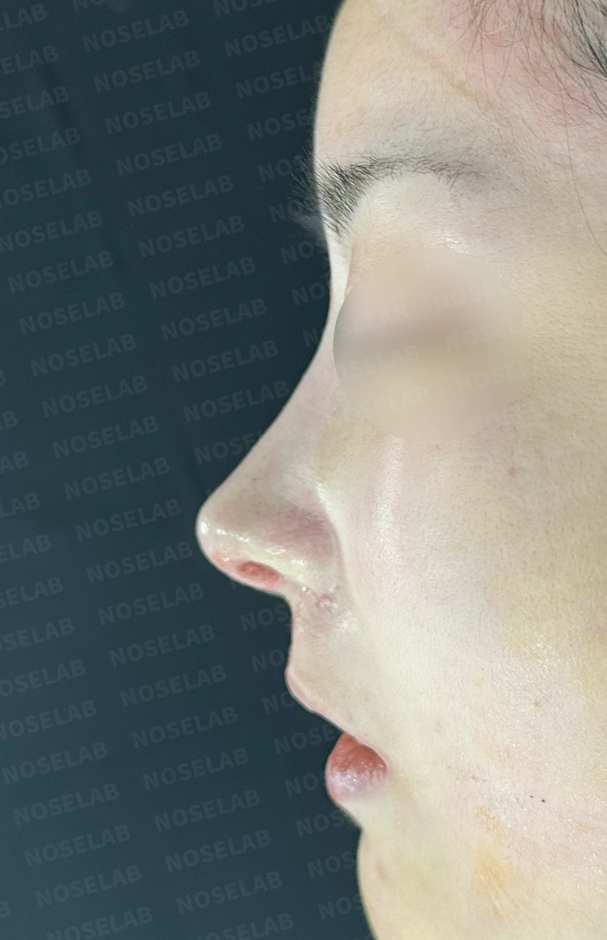 코재수술 뒤 콧대가 붉어 보이는 이유와 재건 방법 — 수술 직후 0일 정면, 측면, 비스듬한 측면 사진입니다. 직후 사진은 부기가 있는 상태로 최종 결과와 다를 수 있습니다.