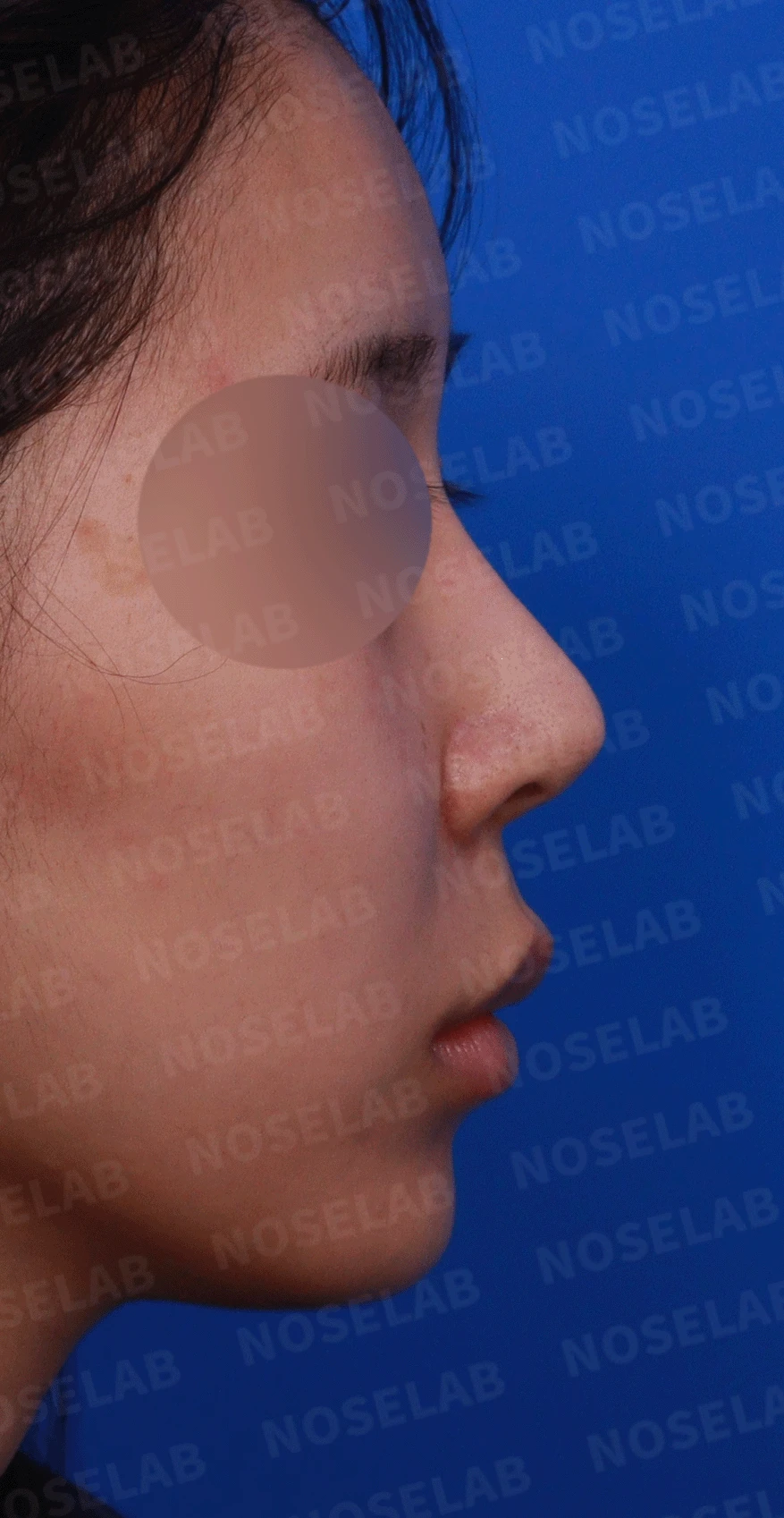 여러 번 수술한 코에 연골이 비치는 이유와 점막·구조 복원 방법 — 디자인 상담 우측 측면 , 비스듬한 측면 , 비공 사진입니다.