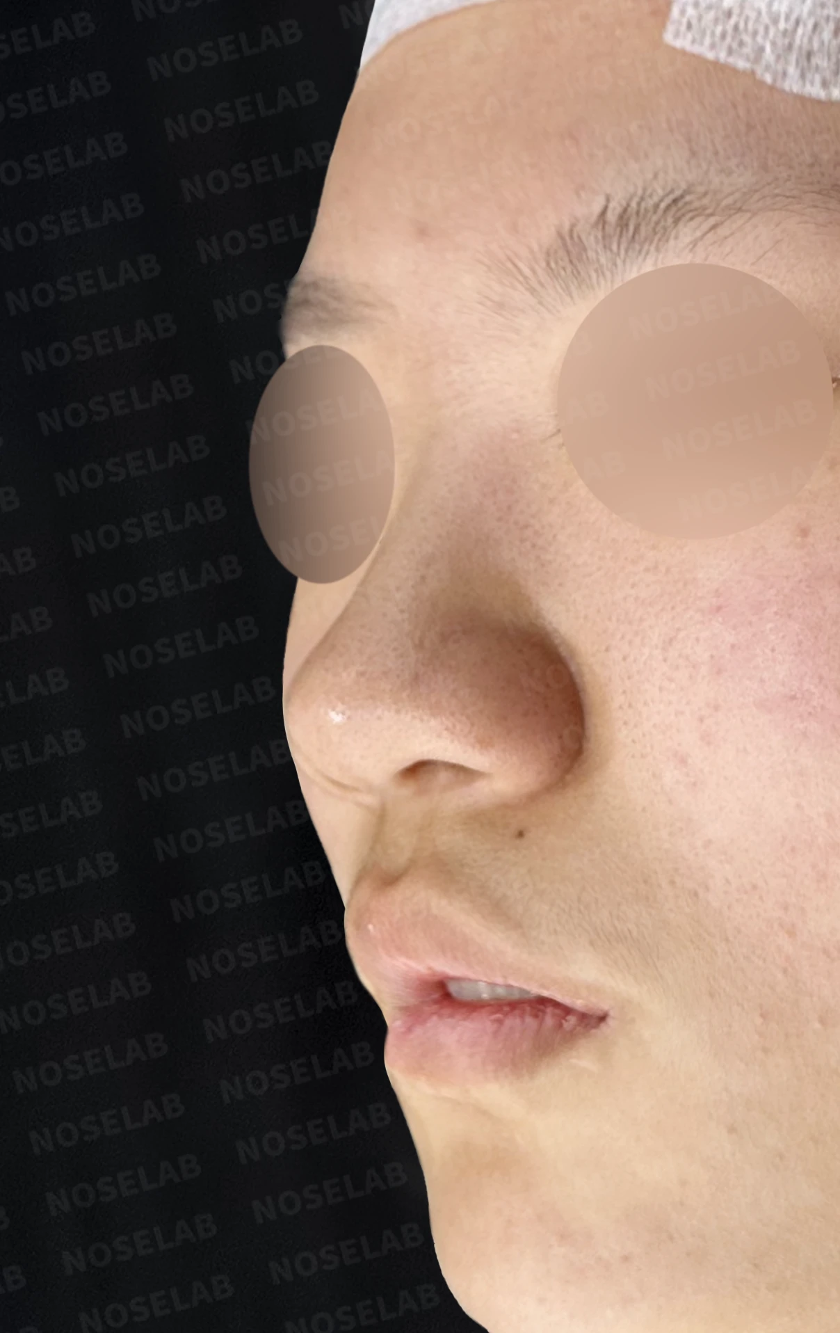 뭉툭한 코끝과 퍼진 코, 자가늑연골 비중격 연장술로 자연스럽게 교정 — 전(좌) 직후(후)