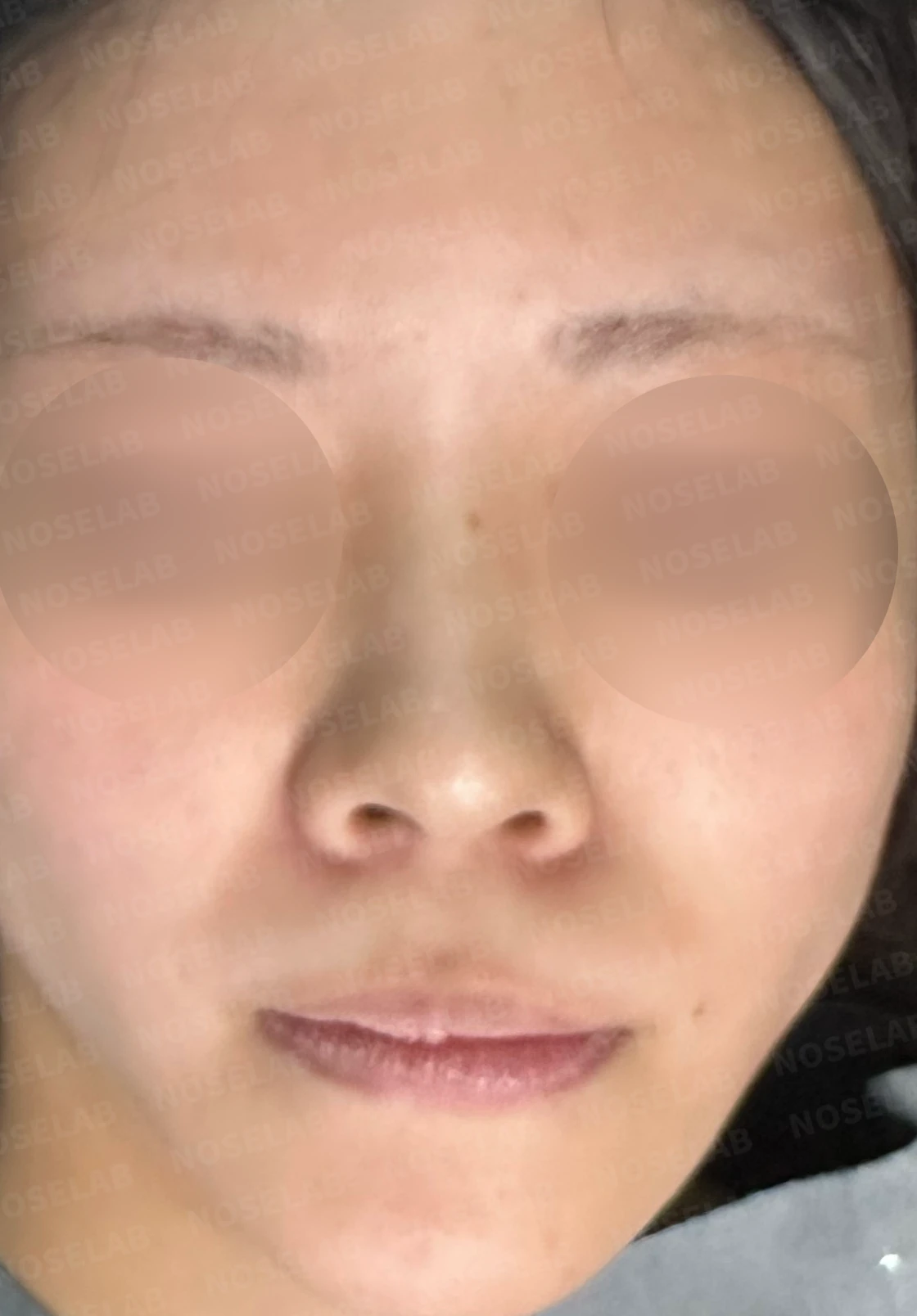 필러 맞고 퍼진 코 교정 방법 — 수술 전 / 수술 직후 0일 직후 사진은 부기가 있는 상태로 최종 결과와 다를 수 있습니다.