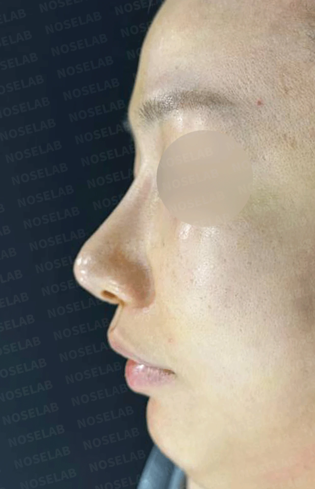 코끝 고어텍스가 문제를 일으키는 이유와 늑연골 비중격 재건 방법 — 수술 전 / 수술 직후 0일 직후 사진은 부기가 있는 상태로 최종 결과와 다를 수 있습니다.