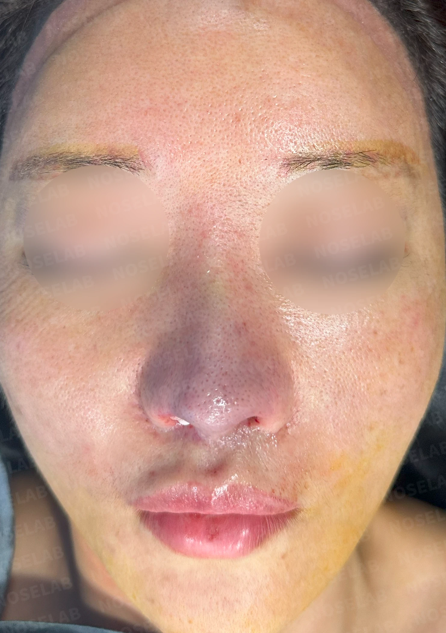콧볼축소 후 남은 조직을 고려한 재수술 방법 — 수술 전 / 수술 직후 0일 직후 사진은 부기가 있는 상태로 최종 결과와 다를 수 있습니다.
