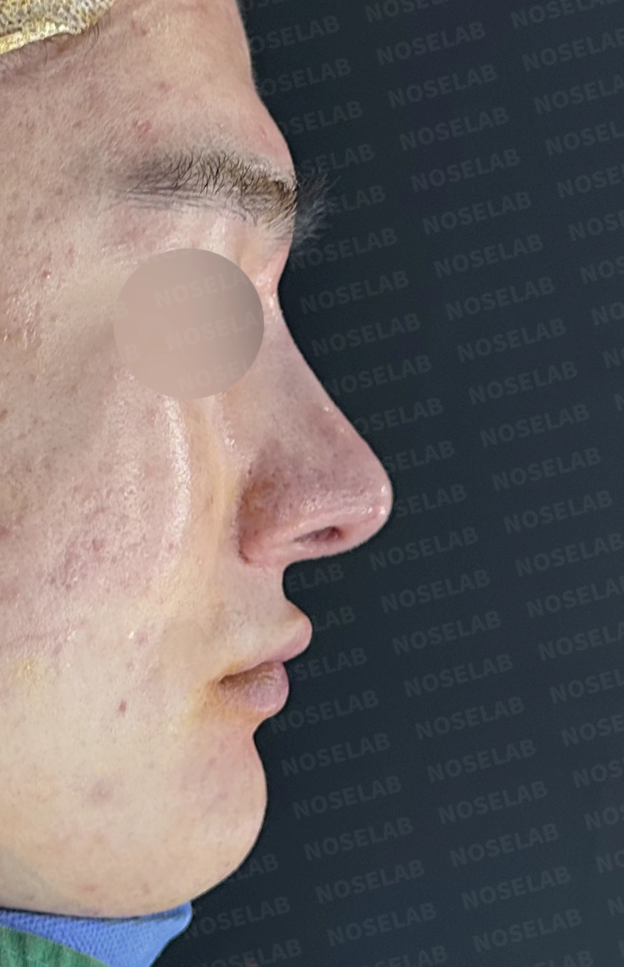 콧대를 더 높이고 싶을 때 무엇이 한계를 만드나, 3D 맞춤 보형물과 자가늑연골 코끝 지지 — 수술 전 / 수술 직후 0일 직후 사진은 부기가 있는 상태로 최종 결과와 다를 수 있습니다.