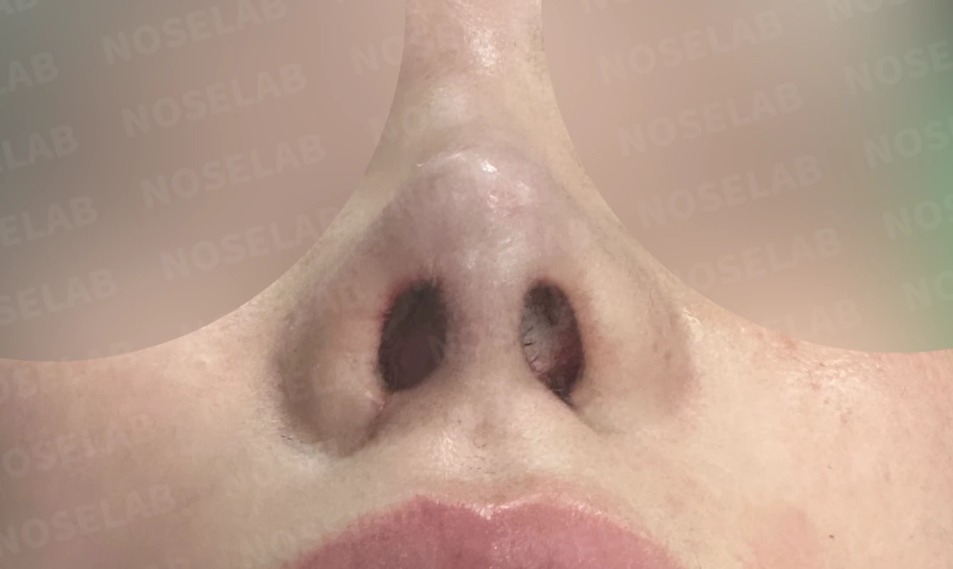 자가 늑연골 코재수술, 콧대부터 코끝까지 슬림하고 여성스럽게 — 전(좌) 직후(후)