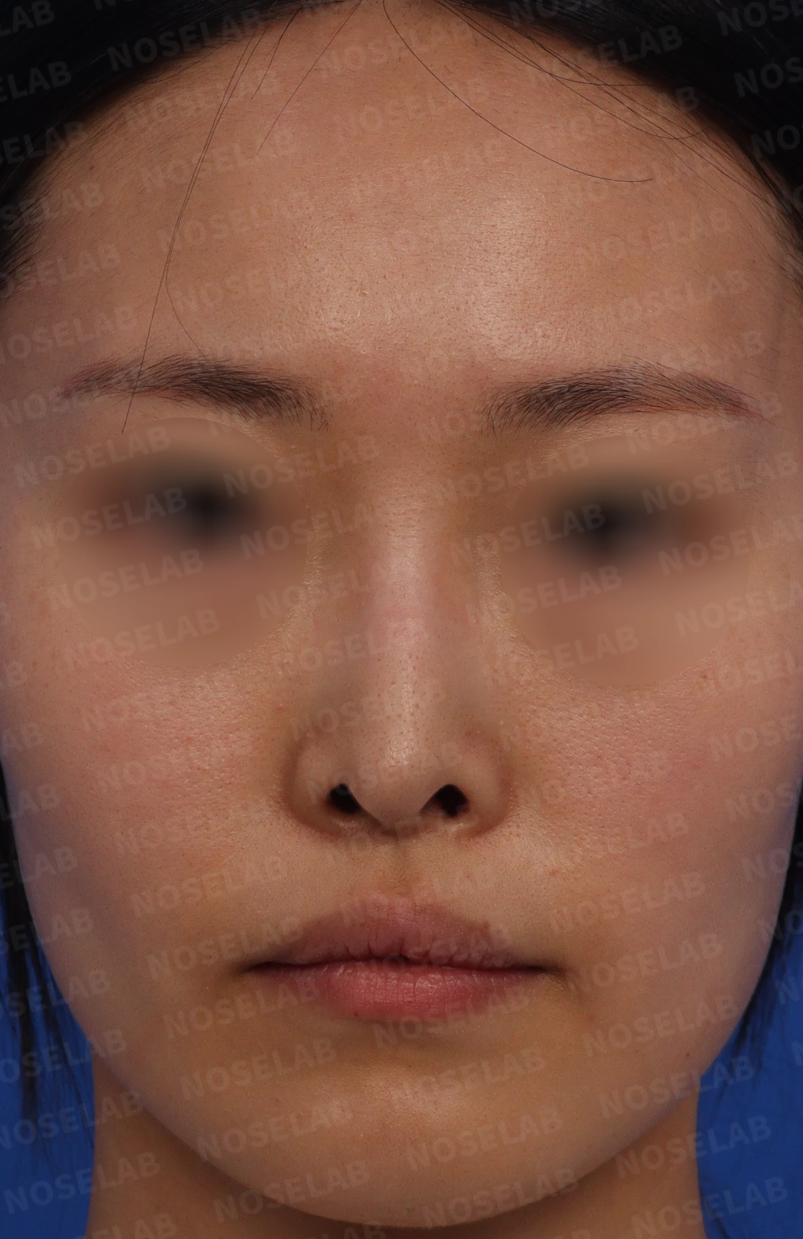 피부가 얇고 작은 들창코의 비대칭과 기능 교정 방법 — 본문 사진 1