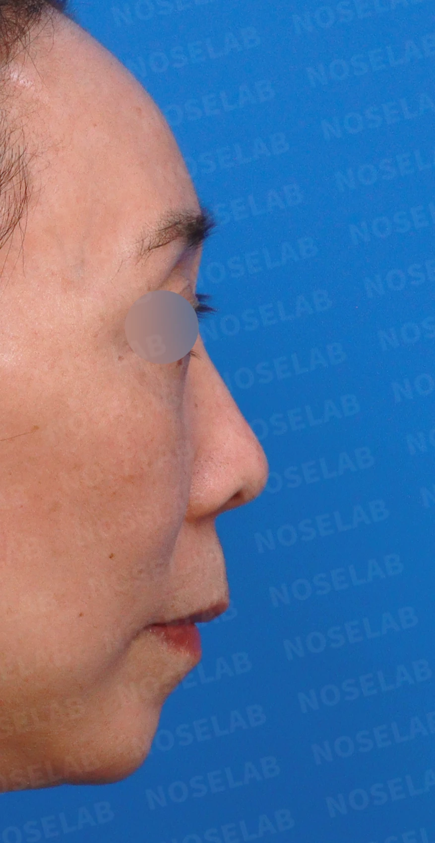 정면에서 콧구멍이 한쪽만 더 보이는 이유와 코끝 재건 방법 — 디자인 상담 우측 측면, 비스듬한 측면, 비공 사진입니다.