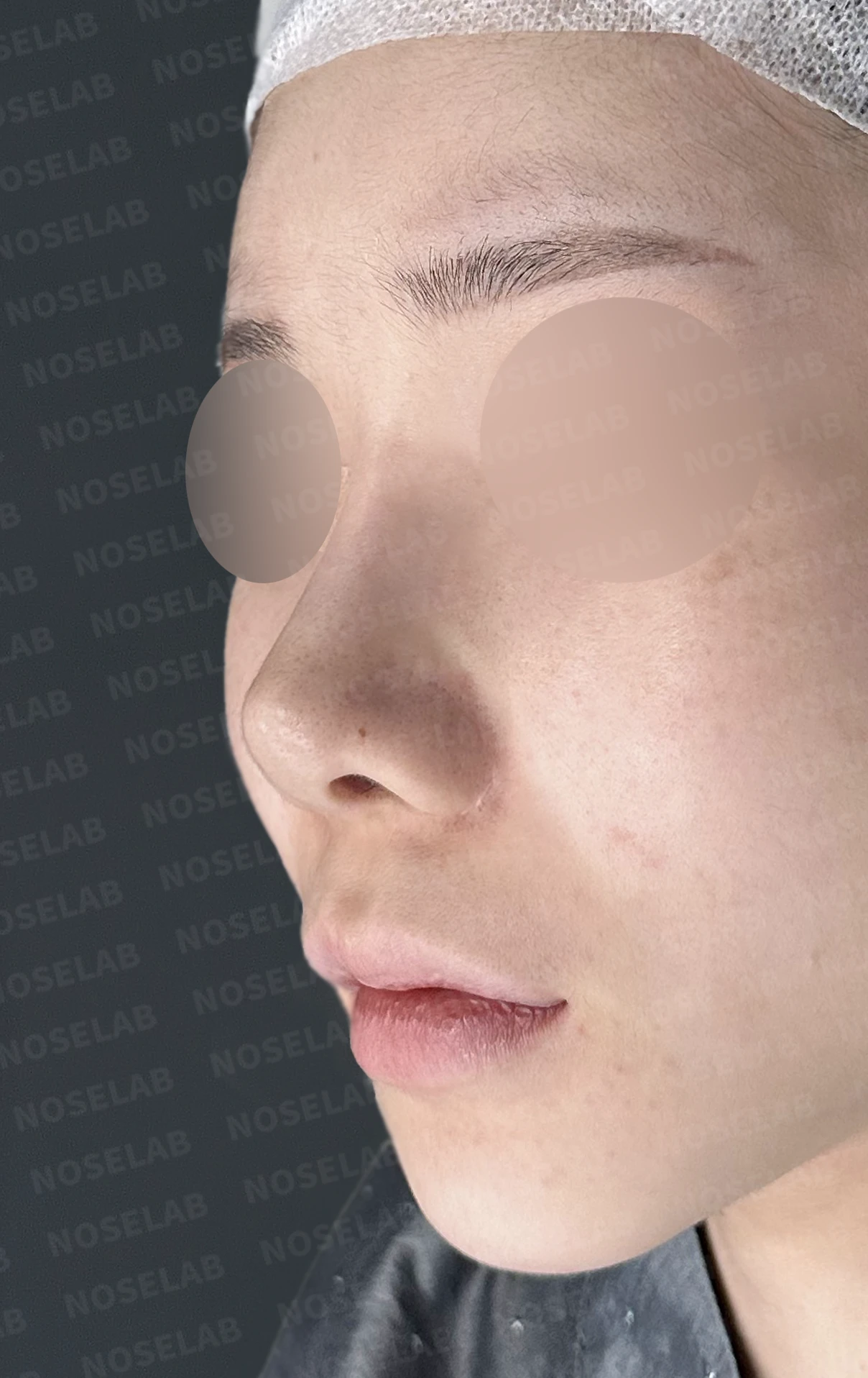 코성형 뒤 코끝이 들리고 비주가 짧아 보이는 이유, 비주 하강과 콧대 라인 교정 방법 — 수술 전 / 수술 직후 0일 직후 사진은 부기가 있는 상태로 최종 결과와 다를 수 있습니다.
