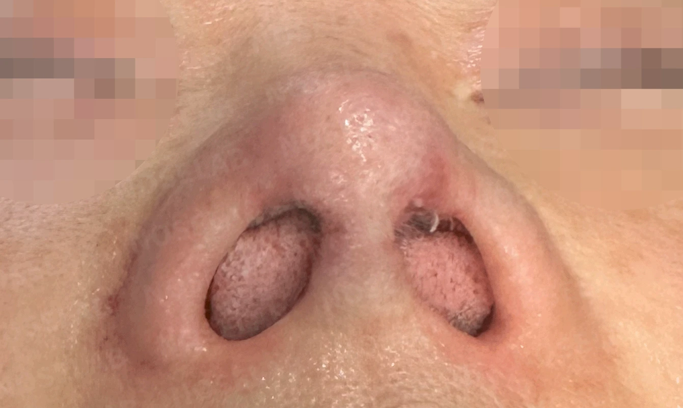 코가 짧고 들리며 비주가 함몰되는 이유, 자가 늑연골 재건은 어떻게 하나 — 수술 직후 0일 비공 사진 직후 사진은 부기가 있는 상태로 최종 결과와 다를 수 있습니다.