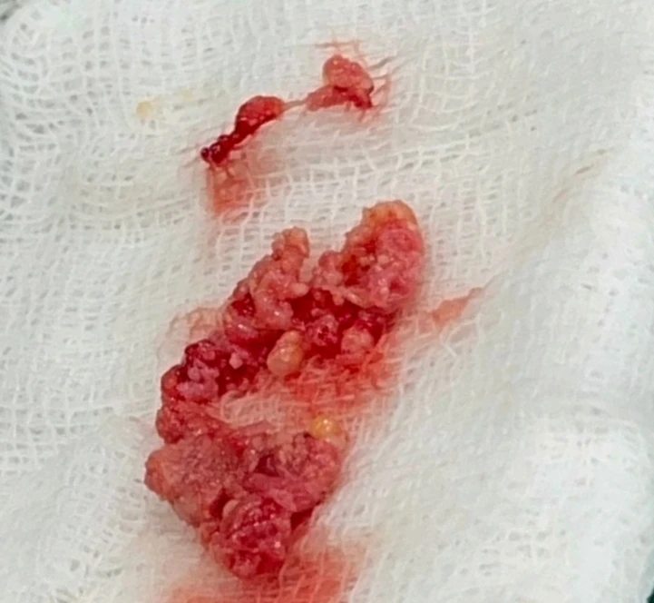 코 안에 남은 메드포어와 이물질, 왜 문제가 되고 어떻게 제거하나 — 제거된 메드포어, 나일론 실, 이물질 사진