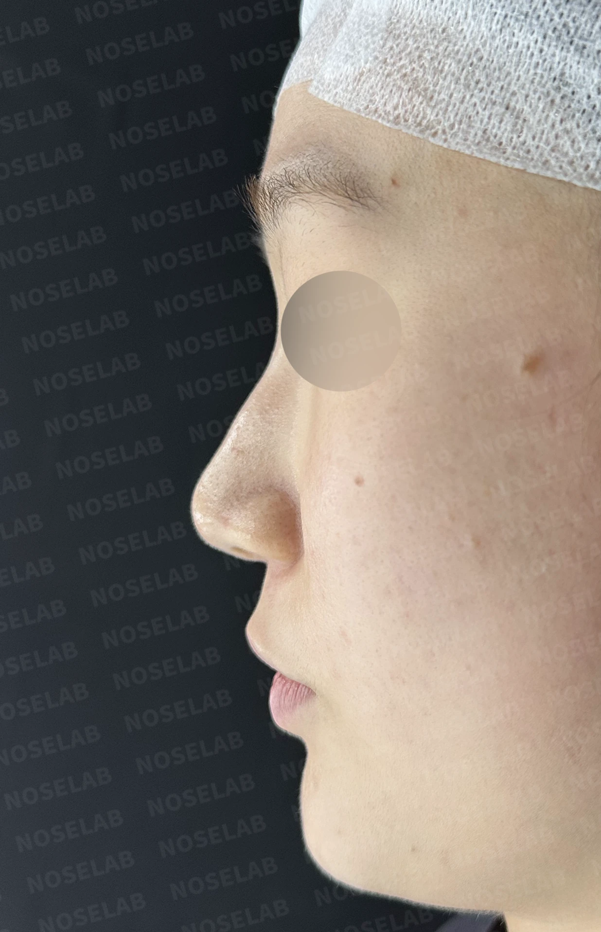 퍼진 코끝에 코막힘이 함께 오는 이유, 이물질 제거와 재건은 어떻게 하나 — 수술 전 / 수술 직후 0일 직후 사진은 부기가 있는 상태로 최종 결과와 다를 수 있습니다.