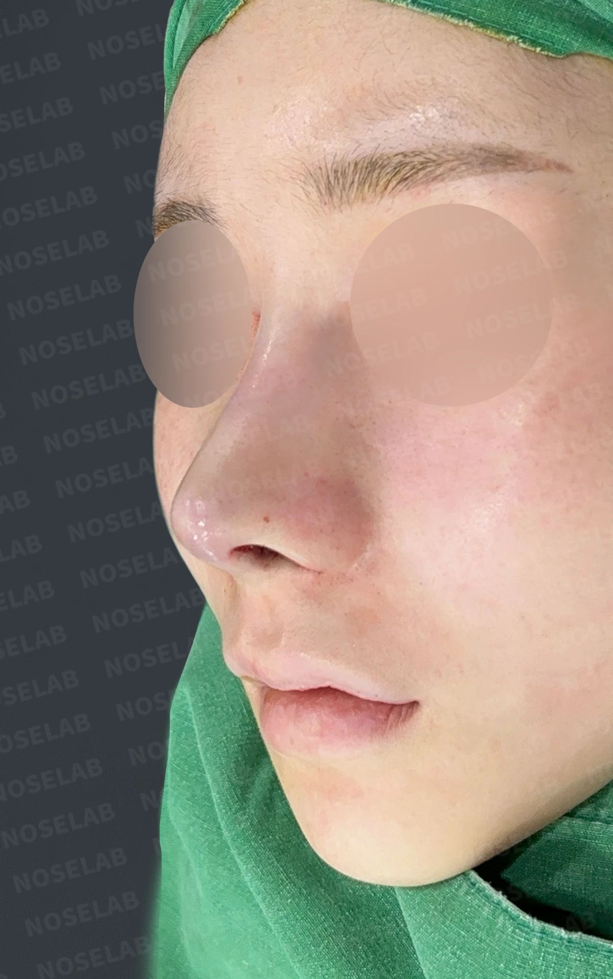 코성형 뒤 코끝이 들리고 비주가 짧아 보이는 이유, 비주 하강과 콧대 라인 교정 방법 — 수술 직후 0일 정면, 비스듬한 측면, 측면 사진입니다. 직후 사진은 부기가 있는 상태로 최종 결과와 다를 수 있습니다.