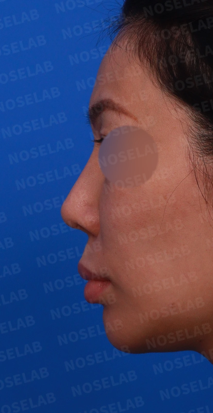 실리텍스 보형물이 비쳐 보이는 이유와 제거 후 재건은 어떻게 하나 — 디자인 상담 정면, 좌측 측면, 비스듬한 측면 사진