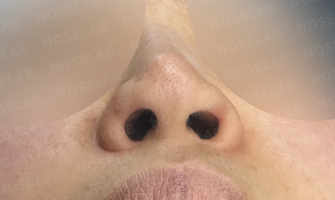보형물 비침과 용코, 자가늑연골로 안전하게 교정한 코재수술 — 전(좌) 직후(후)