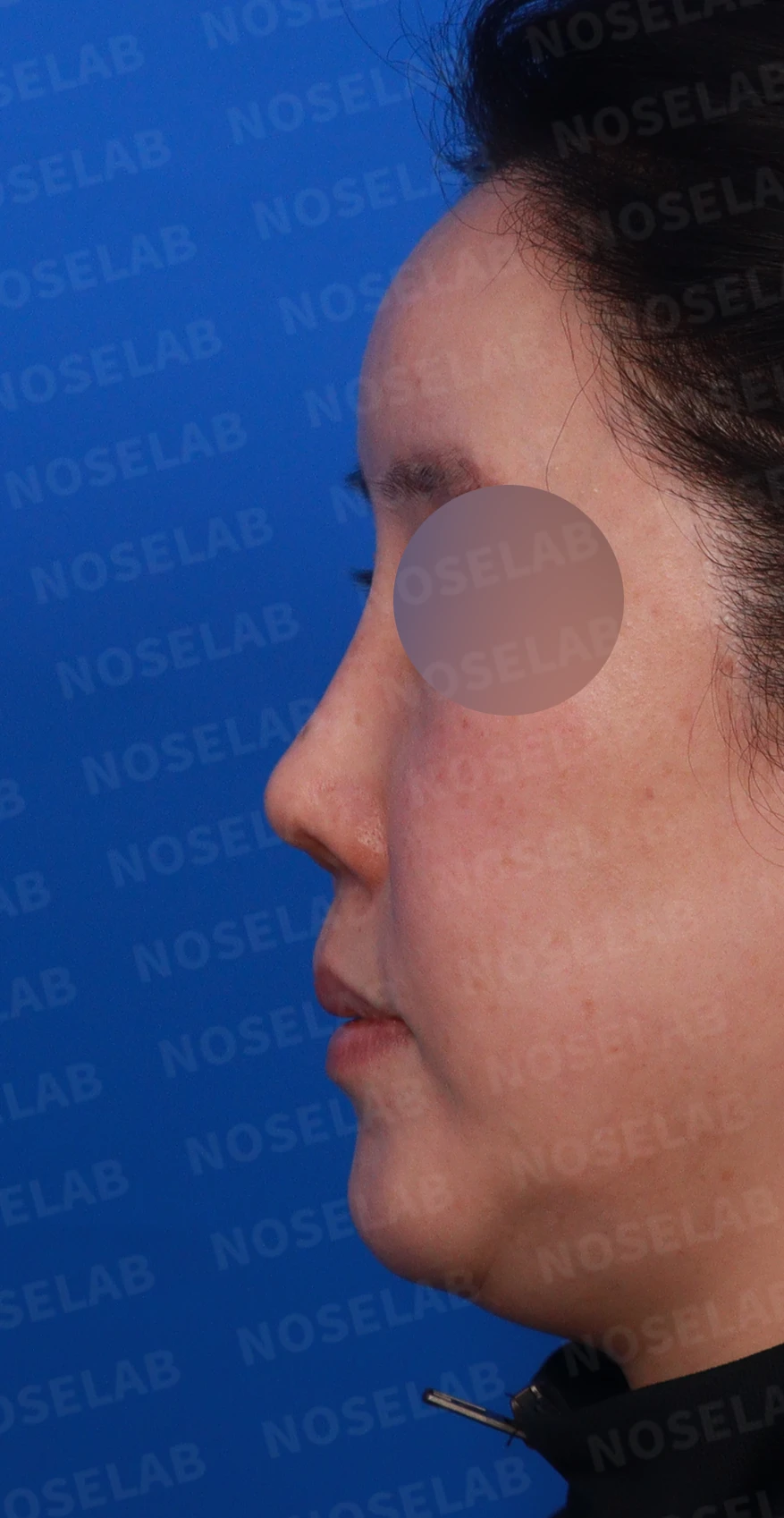 귀족수술 보형물이 코 안으로 밀려 나와 숨이 막히는 이유와 재건 방법 — 디자인 상담 정면, 좌측 , 비스듬한 측면 , 측면 사진입니다.