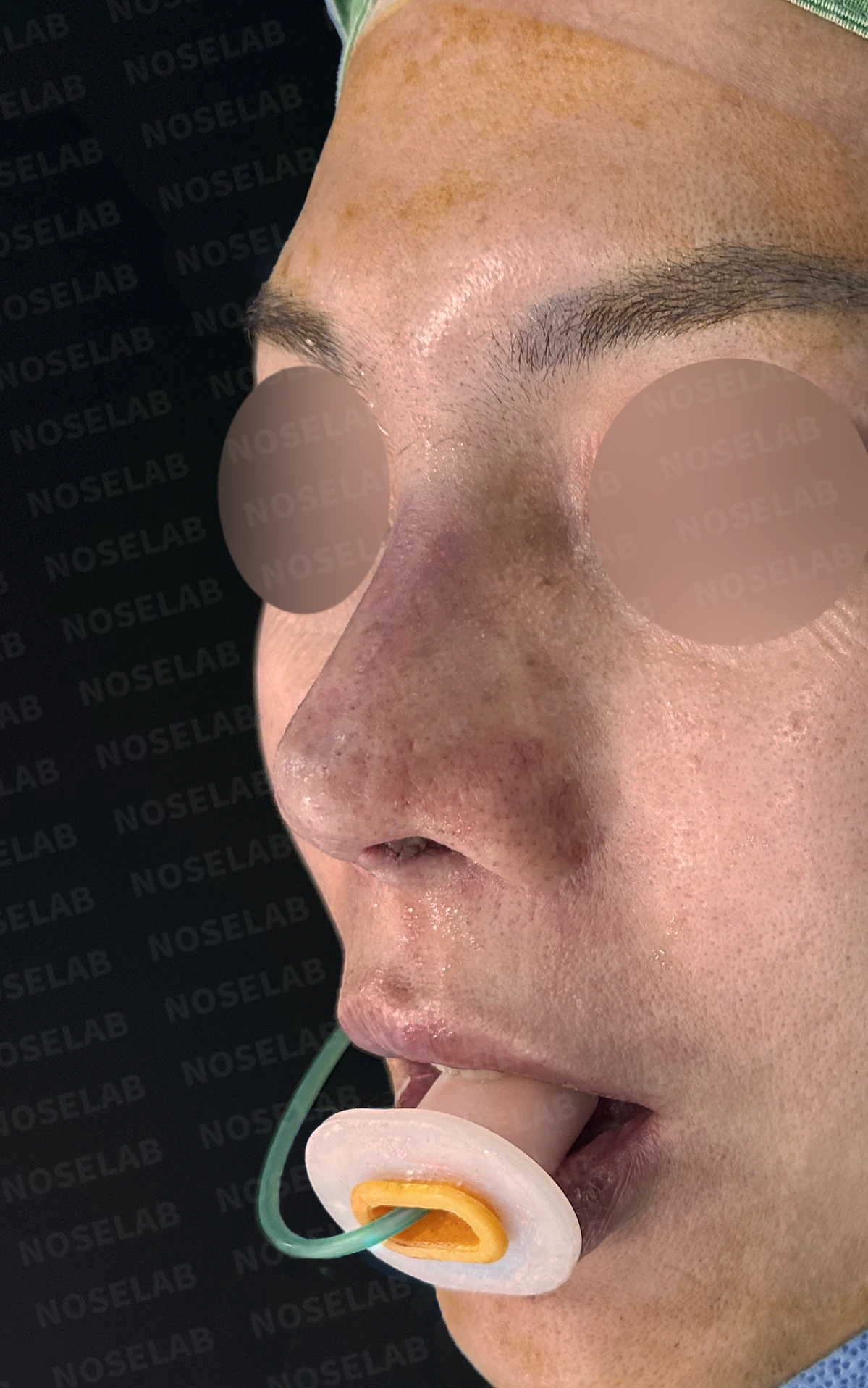 여러 차례 코재수술 후 구축 변형, 자가늑연골로 재건한 사례 — 직후 정면, 비스듬한 측면, 측면 사진입니다.
