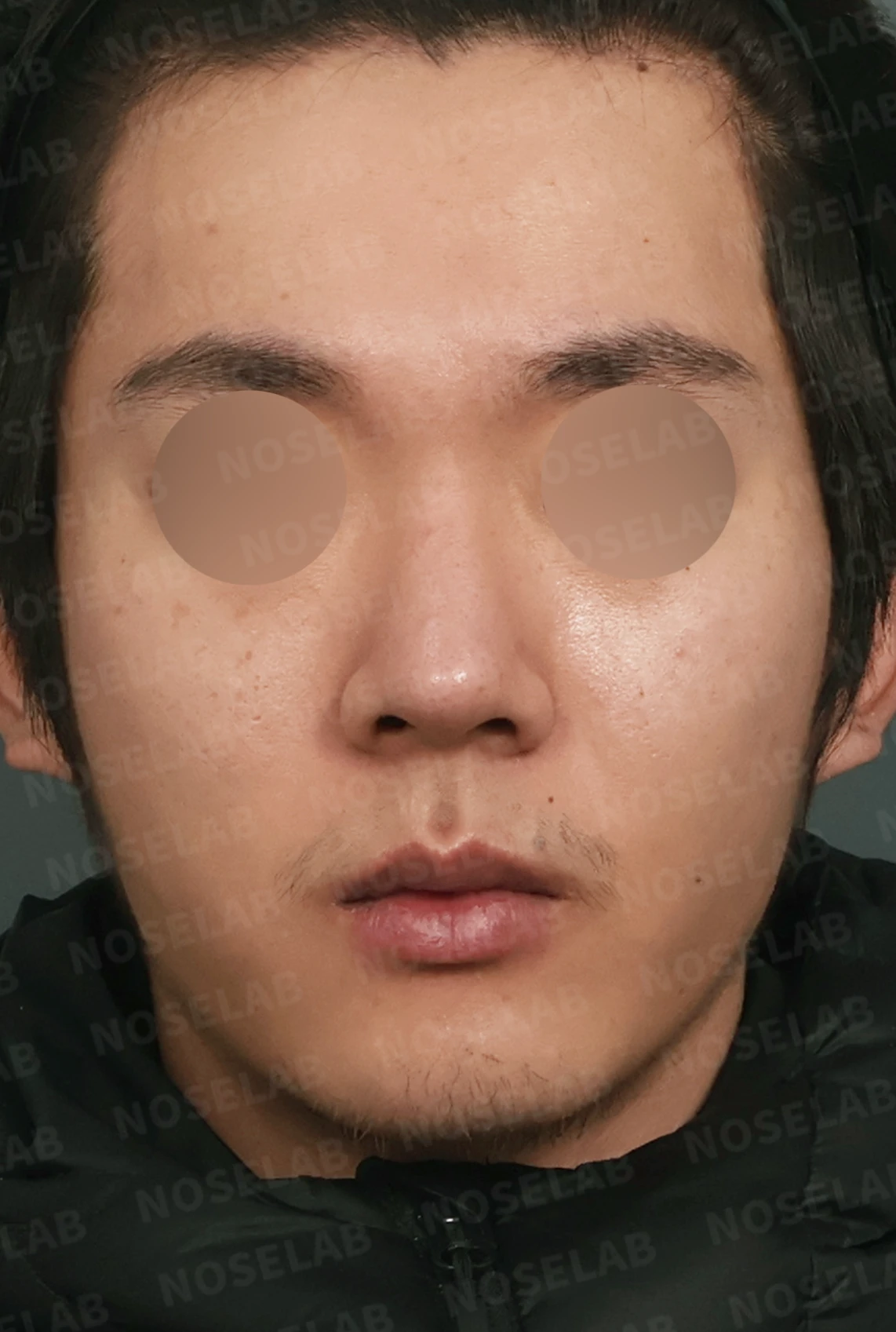 짧고 들린 코, 자가늑연골로 남성적인 라인으로 완성한 코재수술 — 디자인 상담 정면, 비스듬한 측면 , 측면 사진입니다.