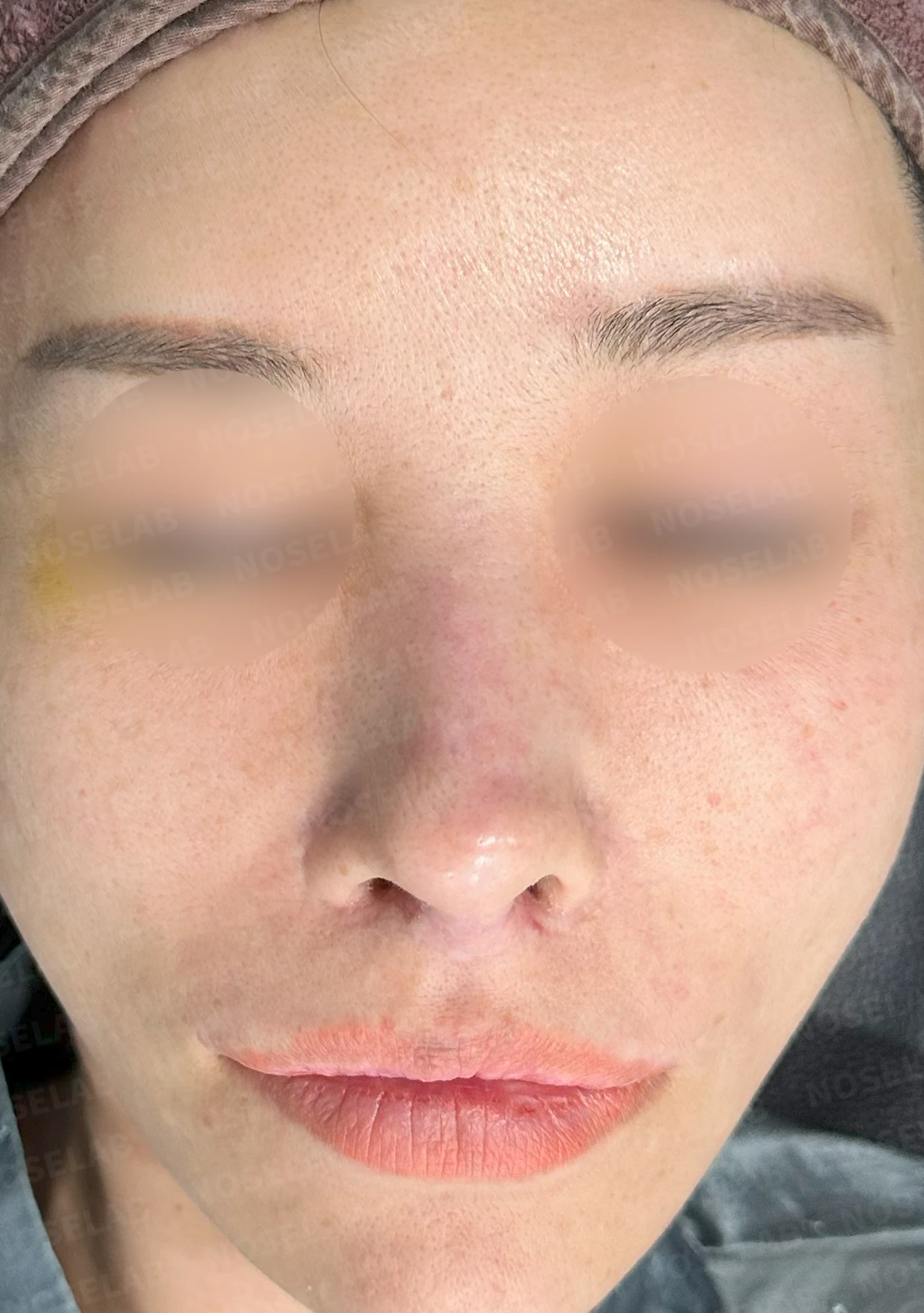 두꺼운 비주와 들린 코끝이 생기는 이유, 자가 늑연골 재건은 어떻게 하나 — 수술 전 / 수술 직후 0일 직후 사진은 부기가 있는 상태로 최종 결과와 다를 수 있습니다.