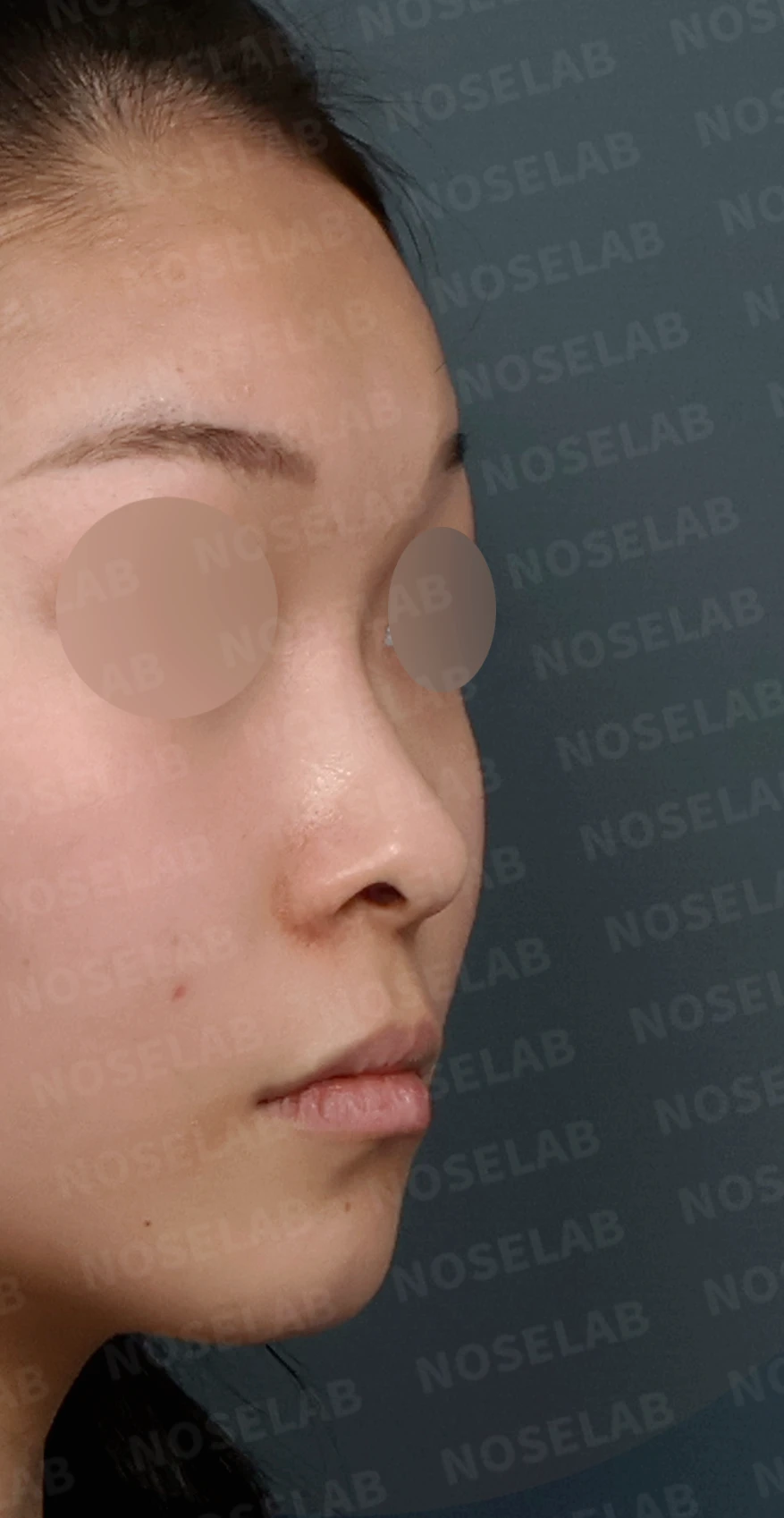 낮고 퍼진 코, 기증늑연골과 실리콘 보형물로 자연스러운 코 라인 완성 — 디자인 상담 우측 측면, 비스듬한 측면, 비공 사진입니다.