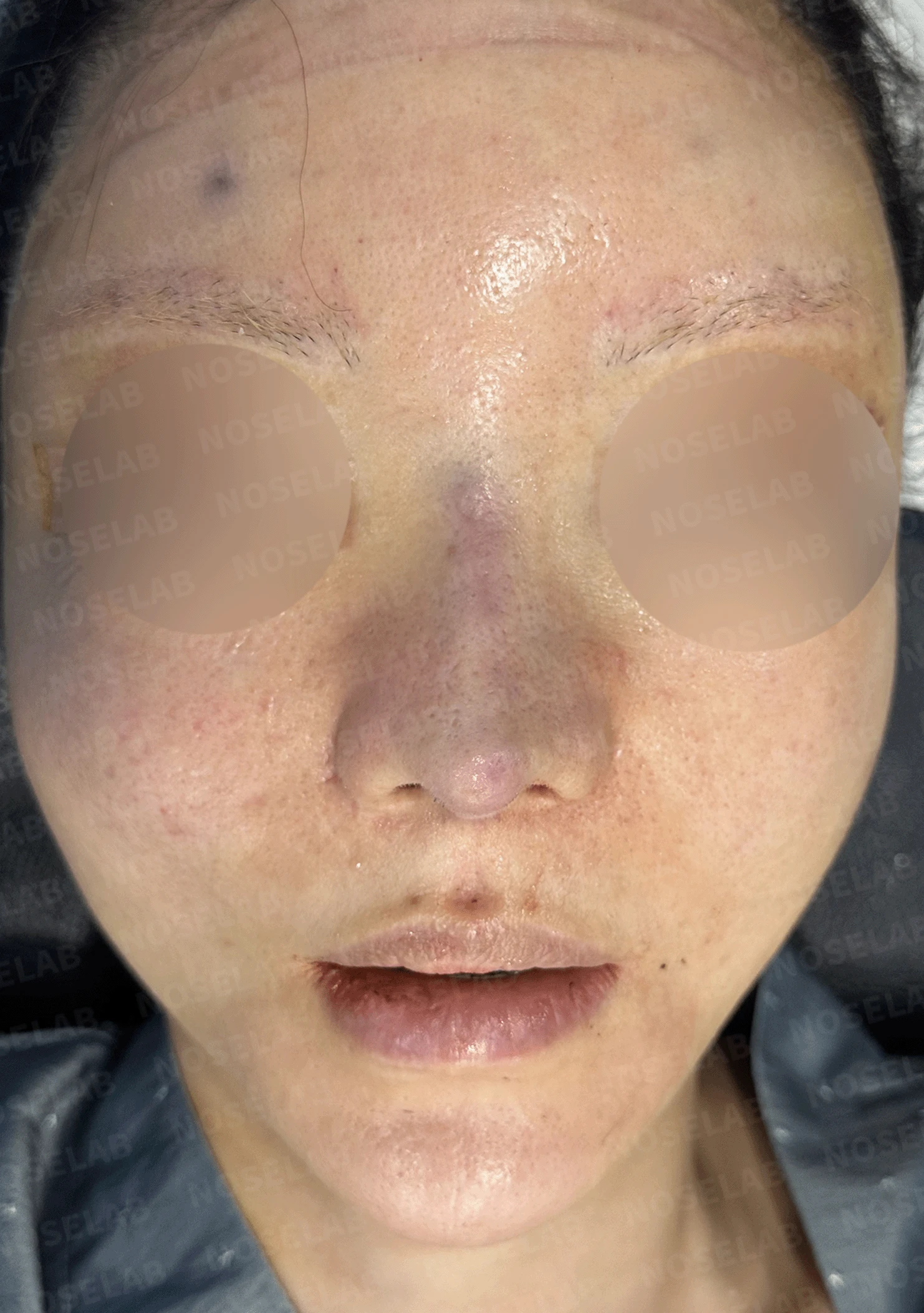 여러 차례 재수술로 코에 쓸 연골이 남지 않았을 때, 재건은 어떻게 하나 — 수술 직후 0일 정면 , 비스듬한 측면 , 측면 사진입니다. 직후 사진은 부기가 있는 상태로 최종 결과와 다를 수 있습니다.
