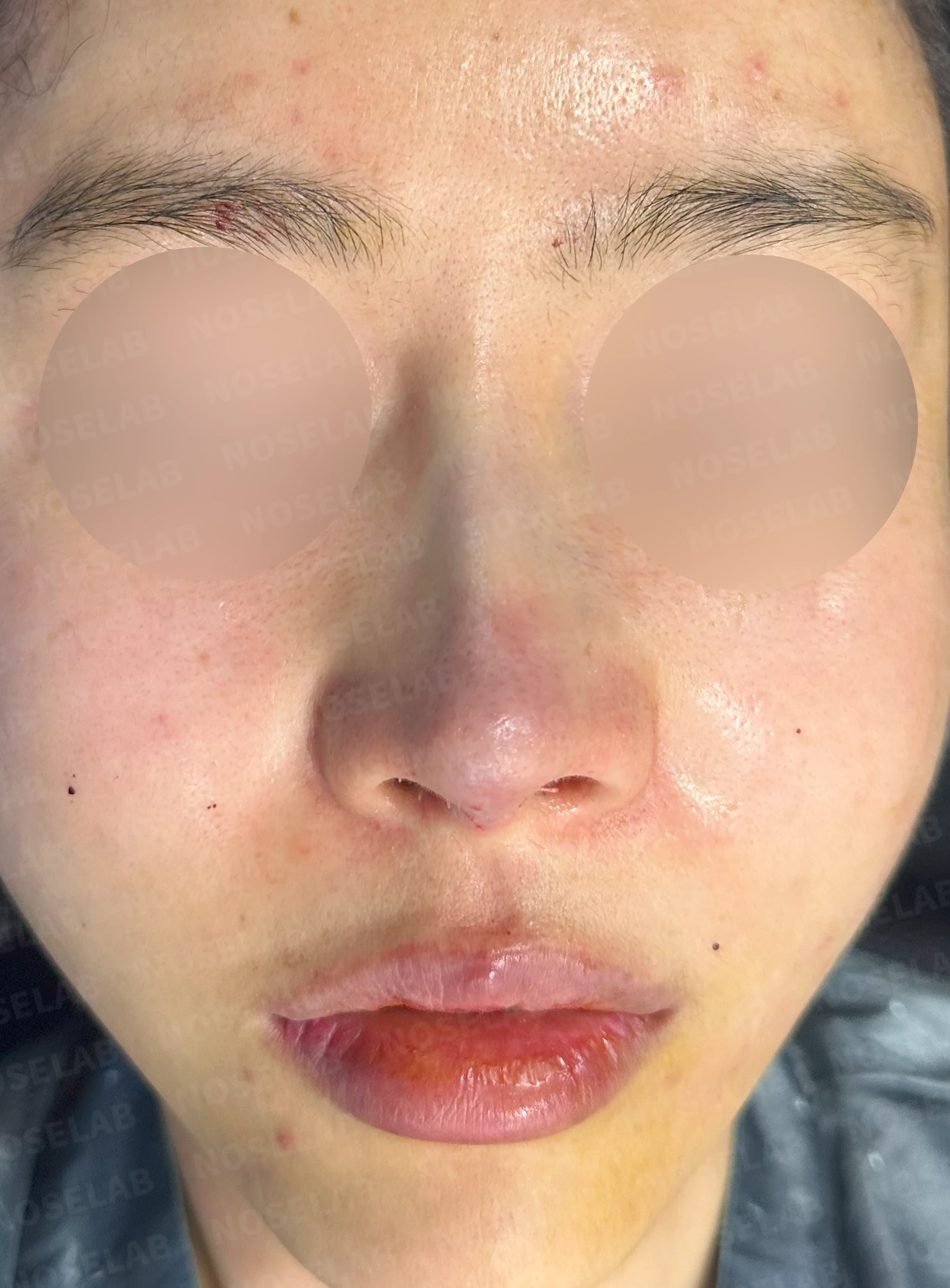코가 들리고 콧기둥이 꺼지며 코끝이 찝혀 보이는 이유, 복합 교정은 어떻게 하나 — 수술 직후 0일 정면, 측면, 비스듬한 측면 사진 직후 사진은 부기가 있는 상태로 최종 결과와 다를 수 있습니다.