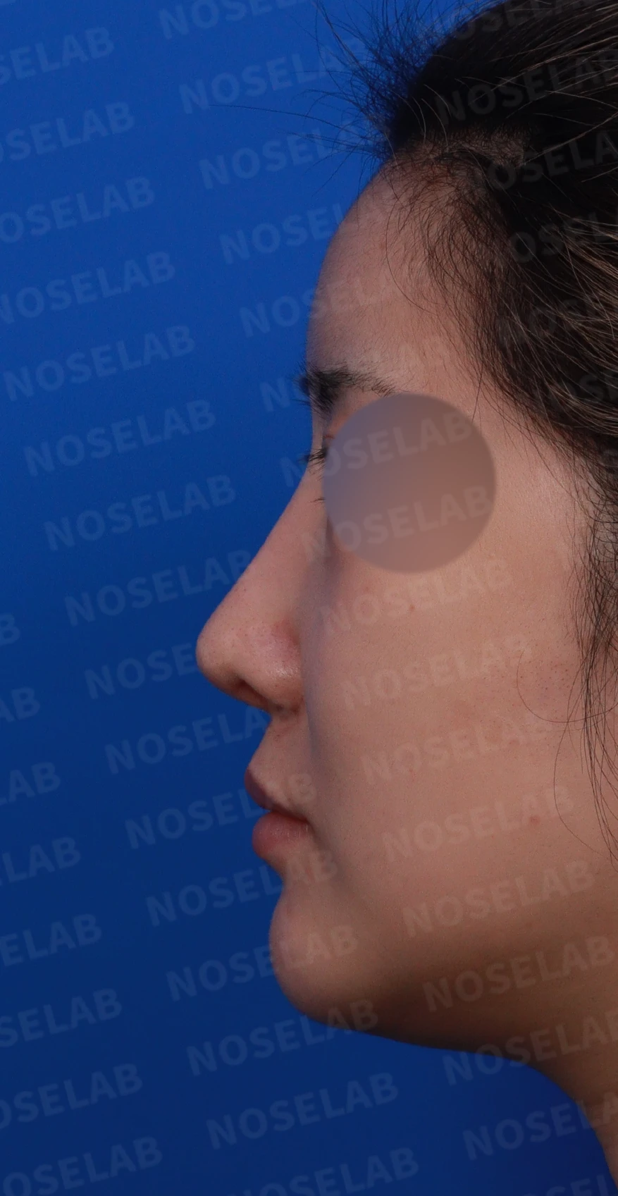 코재수술 뒤 콧대가 붉어 보이는 이유와 재건 방법 — 디자인 상담 정면, 좌측 측면, 비스듬한 측면 사진