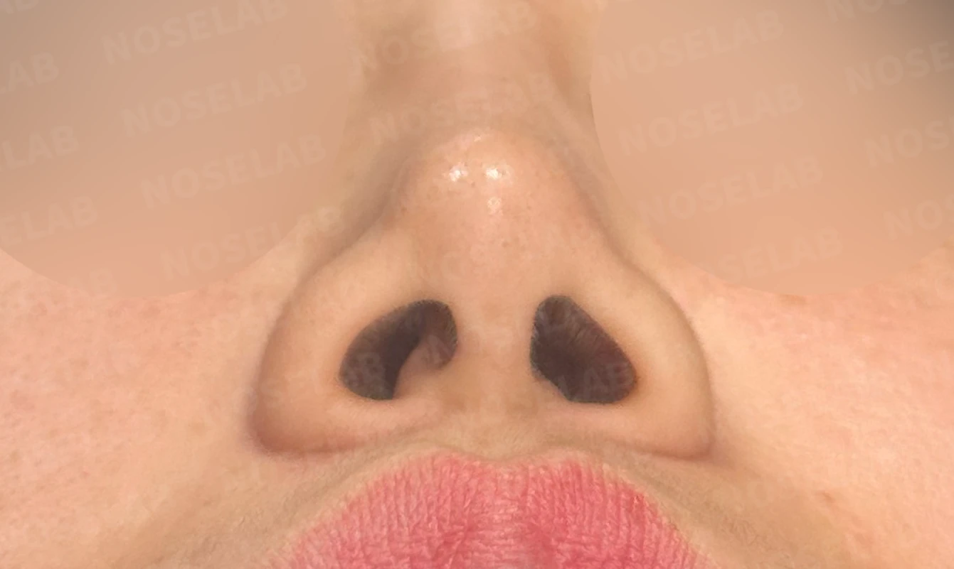 메드포어를 넣은 코에 코막힘이 생기는 이유, 제거와 자가늑연골 비중격 재건은 어떻게 하나 — 수술 전 / 수술 직후 0일 직후 사진은 부기가 있는 상태로 최종 결과와 다를 수 있습니다.