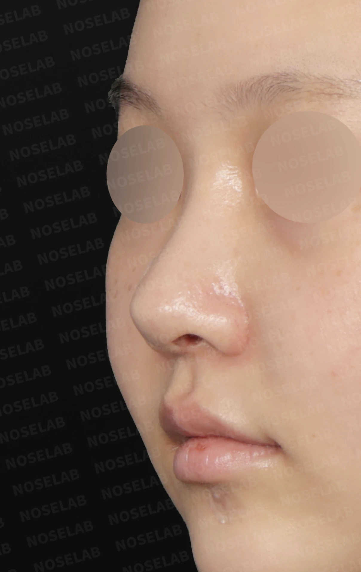 휘어진 코와 복코, 자가늑연골 비중격 재건으로 안전하게 교정한 코재수술 — 전(좌) , 직후(우)