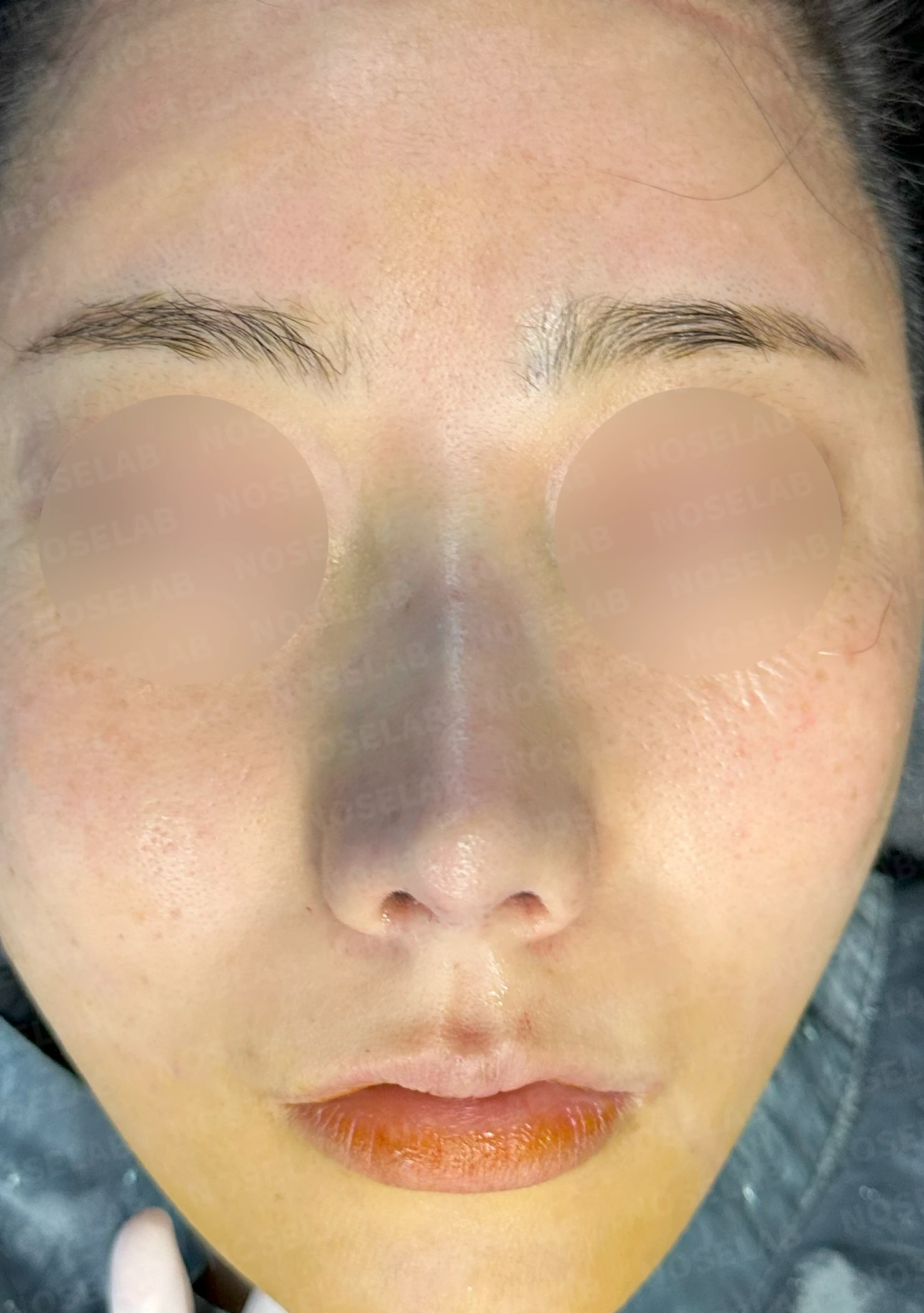 코뼈 비대칭과 처진 코끝에 만성 비염이 겹칠 때 보는 것 — 수술 직후 0일 정면, 비스듬한 측면, 측면 사진입니다. 직후 사진은 부기가 있는 상태로 최종 결과와 다를 수 있습니다.