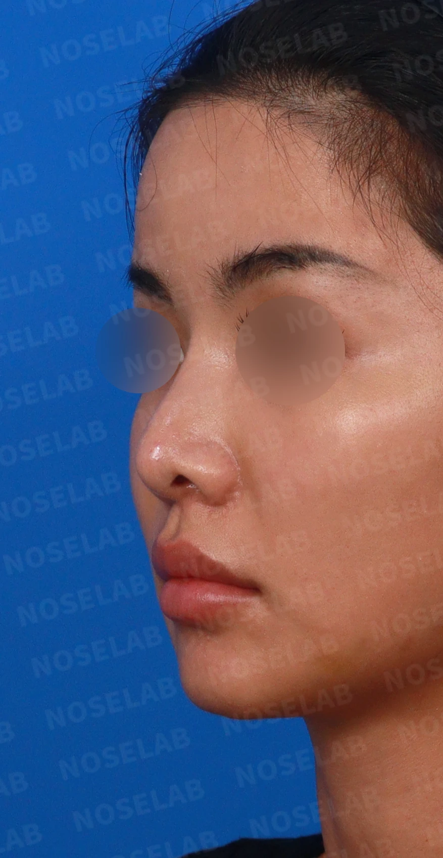 코성형 뒤 코끝이 처지고 웃을 때 퍼지는 이유, 이물질 제거와 코끝 교정 방법 — 디자인 상담 정면, 좌측 측면, 비스듬한 측면 사진입니다.