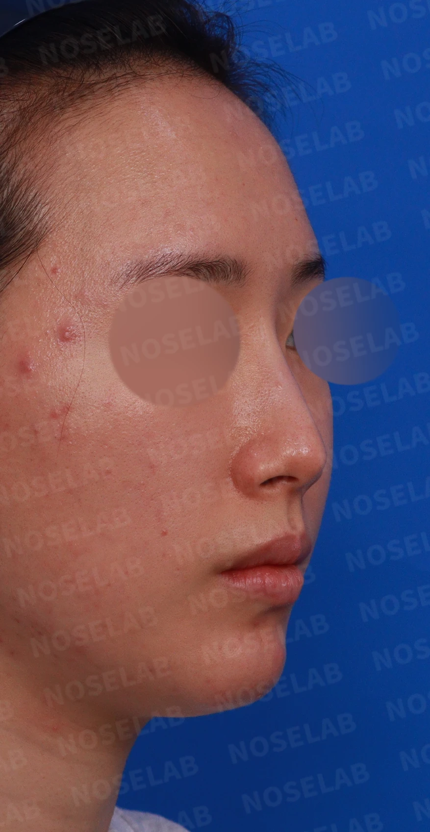 코 필러 뒤에도 휜 코와 코막힘이 남는 이유, 교정은 어떻게 하나 — 디자인 상담 우측 측면, 비스듬한 측면, 비공 사진
