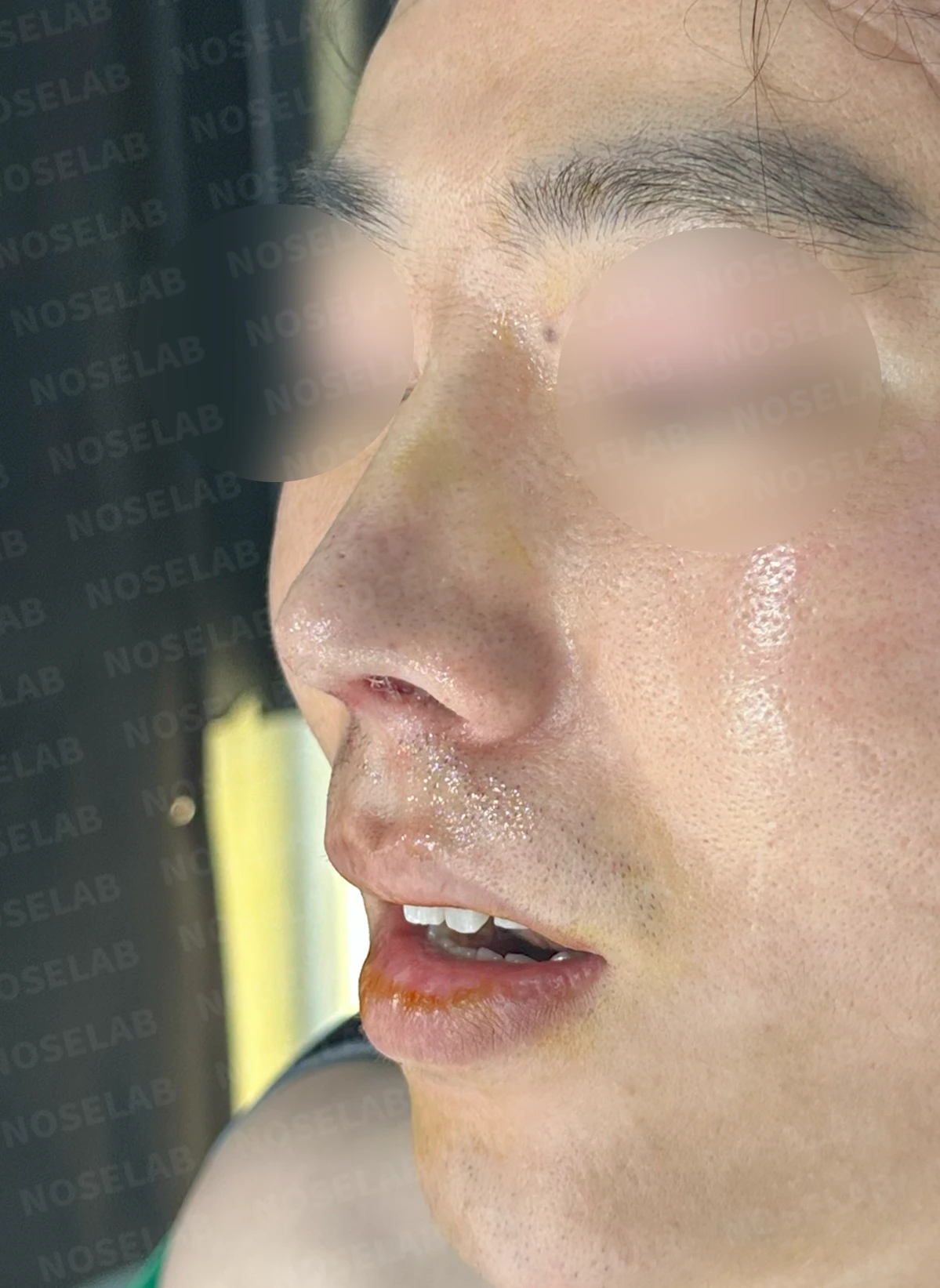 코끝 염증을 겪은 뒤 콧날개가 찝히고 코끝이 꺼지는 이유와 재건 방법 — 수술 직후 0일 정면, 측면, 비스듬한 측면 사진 직후 사진은 부기가 있는 상태로 최종 결과와 다를 수 있습니다.