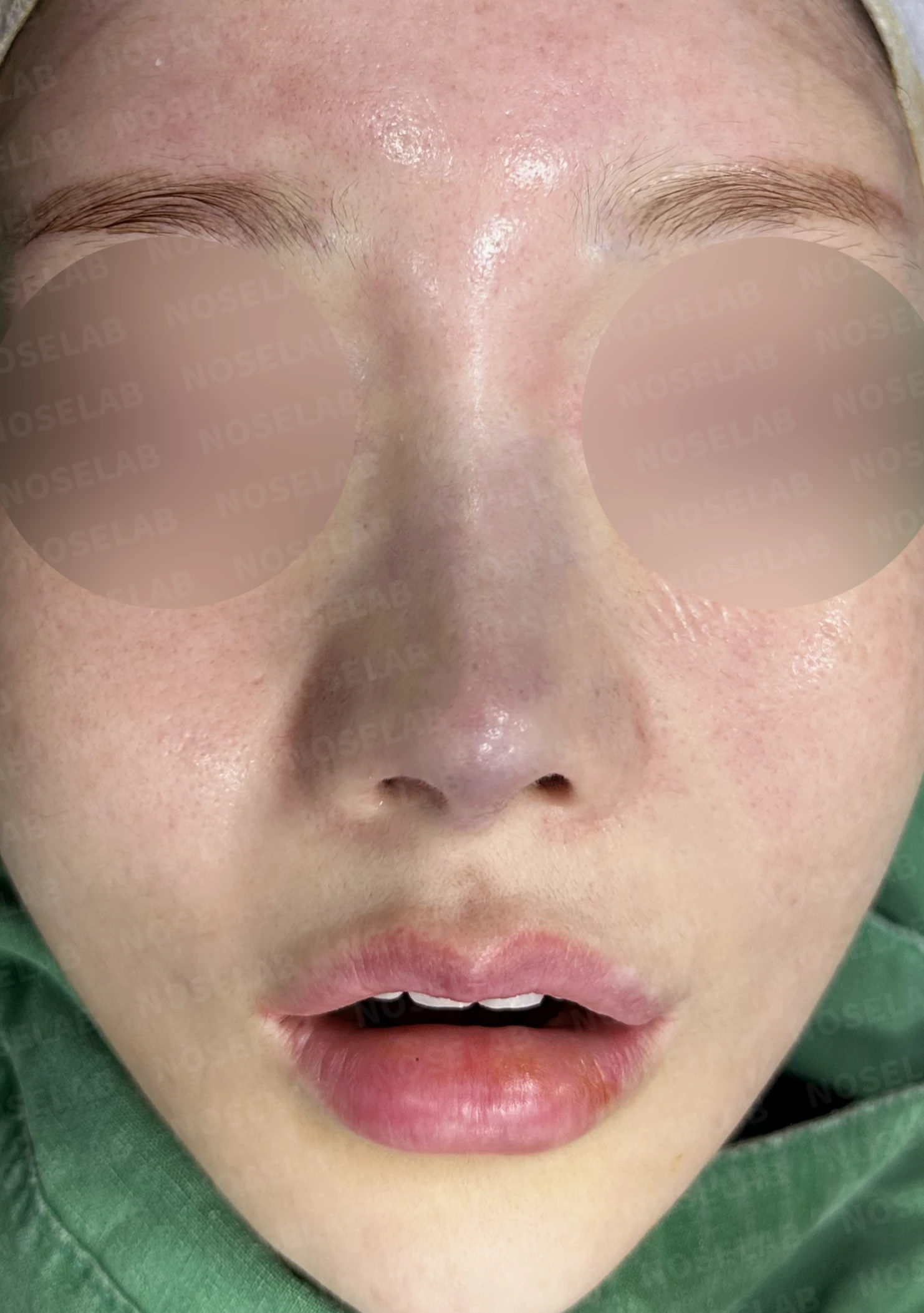 여러 차례 코수술 후 자가늑연골과 자가진피로 코 전체를 자연스럽게 높인 재수술 — 수술직후 정면, 비스듬한 측면, 측면 사진입니다.