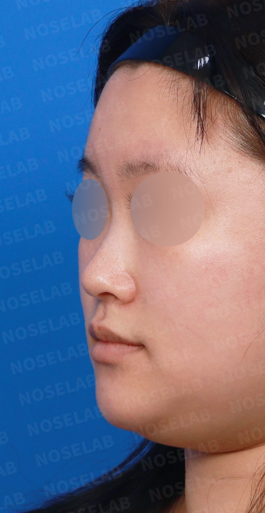 코가 퍼지고 코끝이 뭉툭해 보이는 이유, 비중격연골과 귀연골 교정은 어떻게 하나 — 디자인 상담 정면, 좌측 측면, 비스듬한 측면 사진입니다.