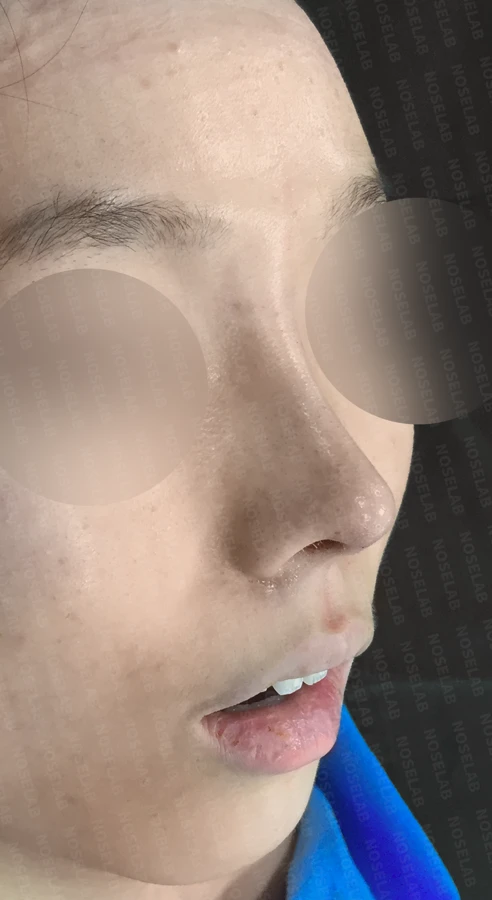 짧은 코의 비개방 교정 방법과 얼굴 비율 — 수술 직후 0일 정면, 측면, 비스듬한 측면 사진입니다. 직후 사진은 부기가 있는 상태로 최종 결과와 다를 수 있습니다.
