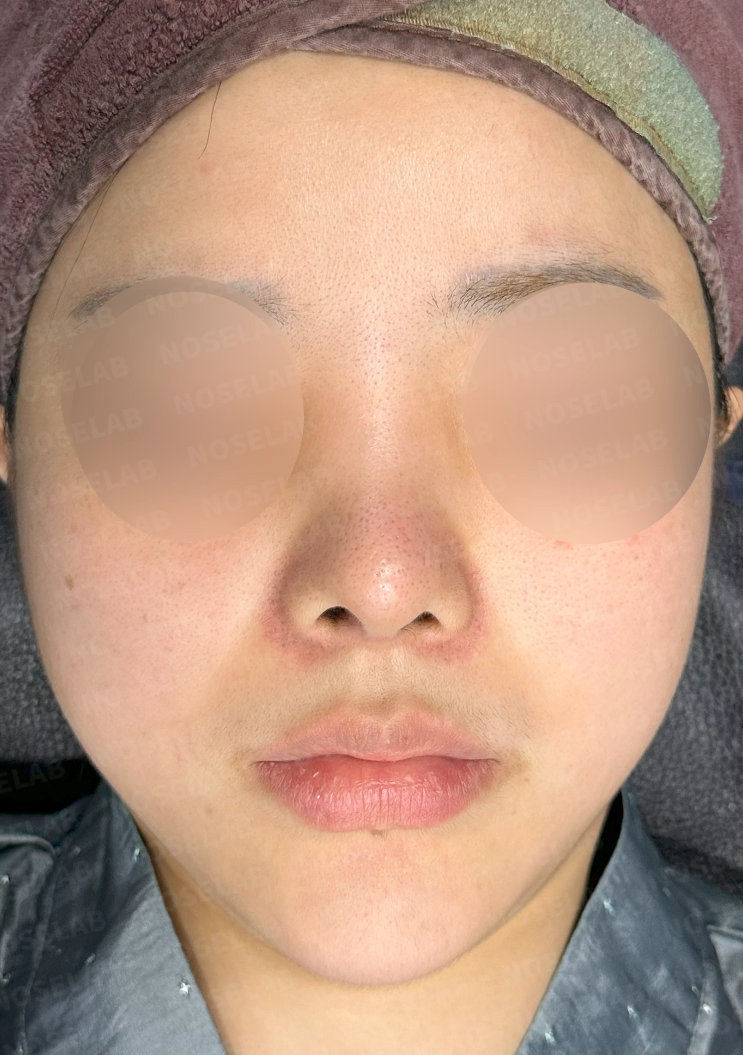 퍼진 콧대와 들린 코끝은 왜 생기나, 늑연골 재건은 어떻게 하나 — 수술 전 / 수술 직후 0일 직후 사진은 부기가 있는 상태로 최종 결과와 다를 수 있습니다.