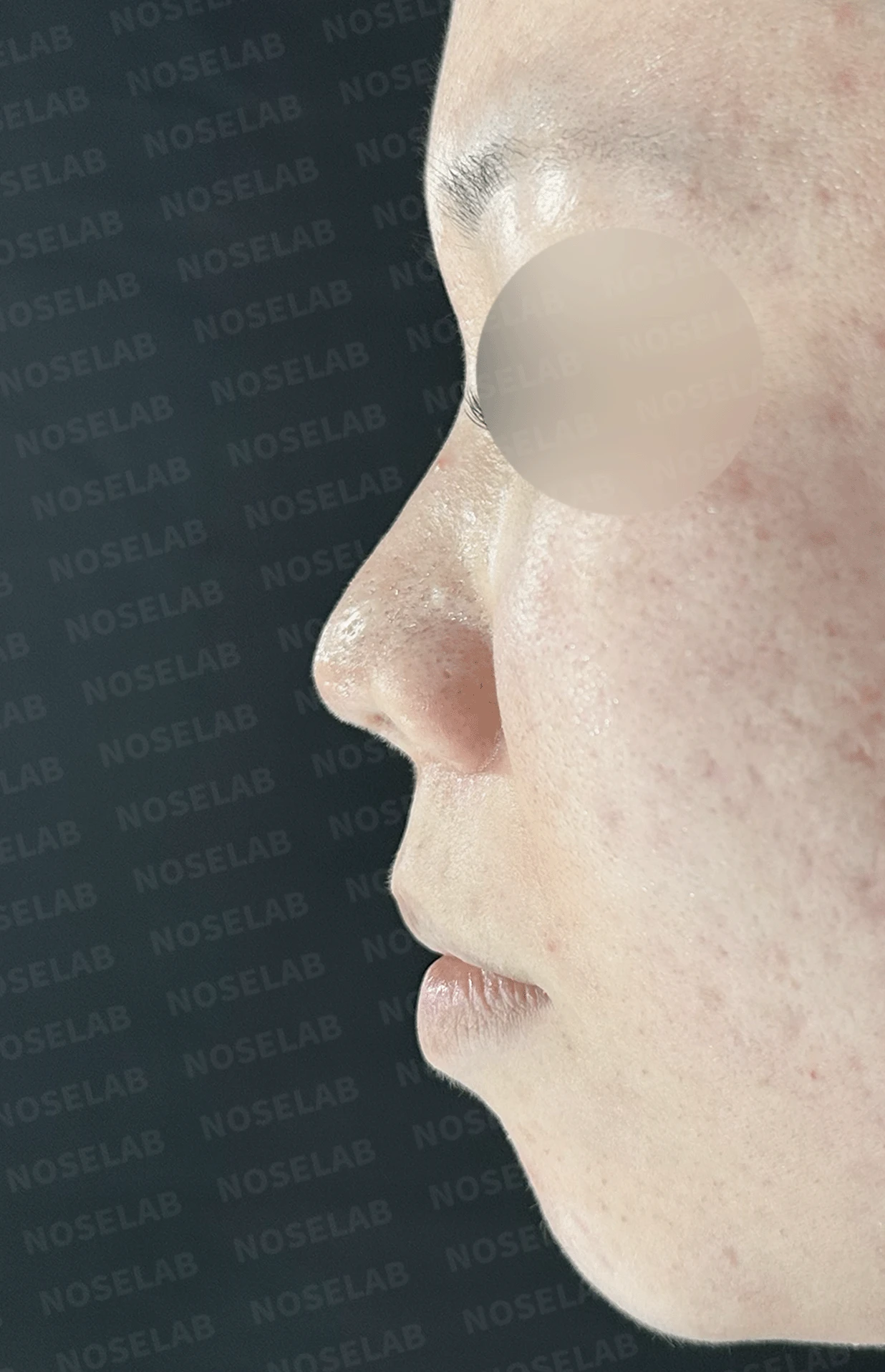 콧구멍을 막는 종괴가 생기는 이유, 제거와 재건은 어떻게 하나 — 본문 사진 17