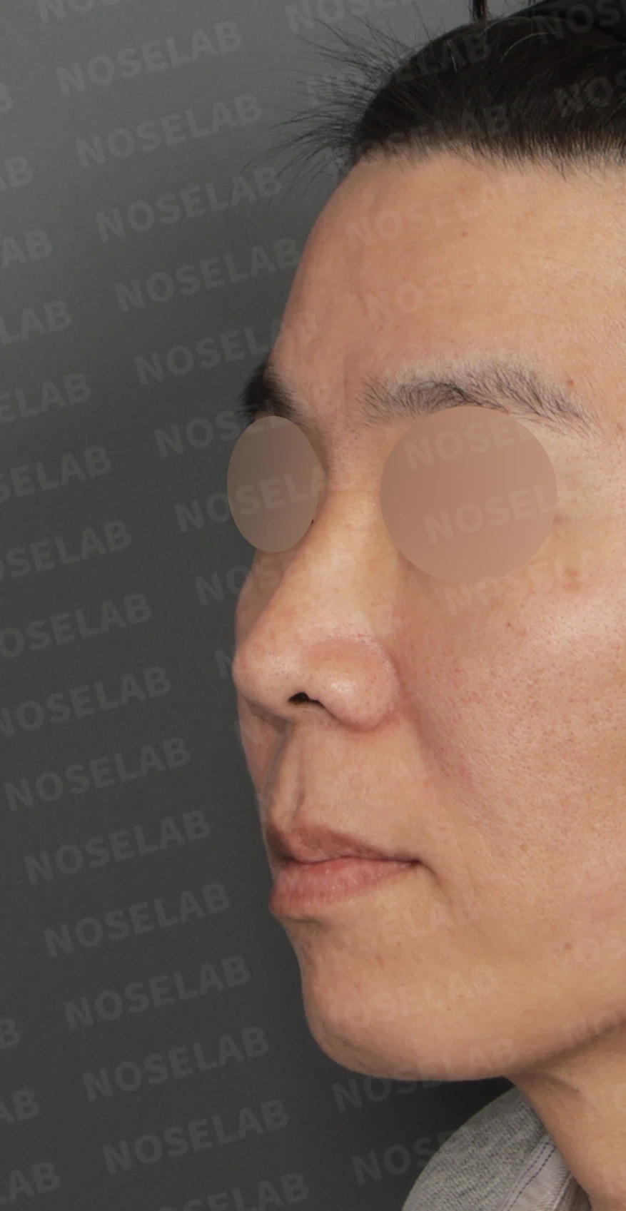 짧고 들린 코와 긴 인중, 자가늑연골로 완성한 남성스러운 직선코 — 디자인 상담 정면, 좌측 측면, 비스듬한 측면