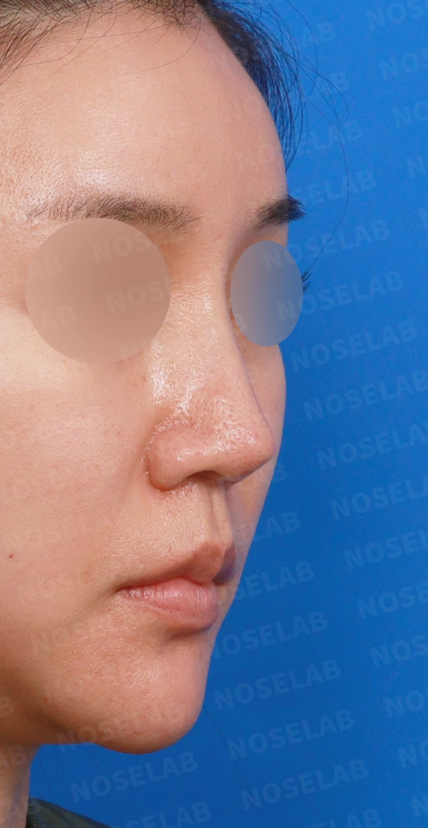 영구 필러가 코 모양을 바꾸는 과정과 제거 후 재건 방법 — 디자인 상담 우측 측면, 비스듬한 측면, 비공 사진입니다.