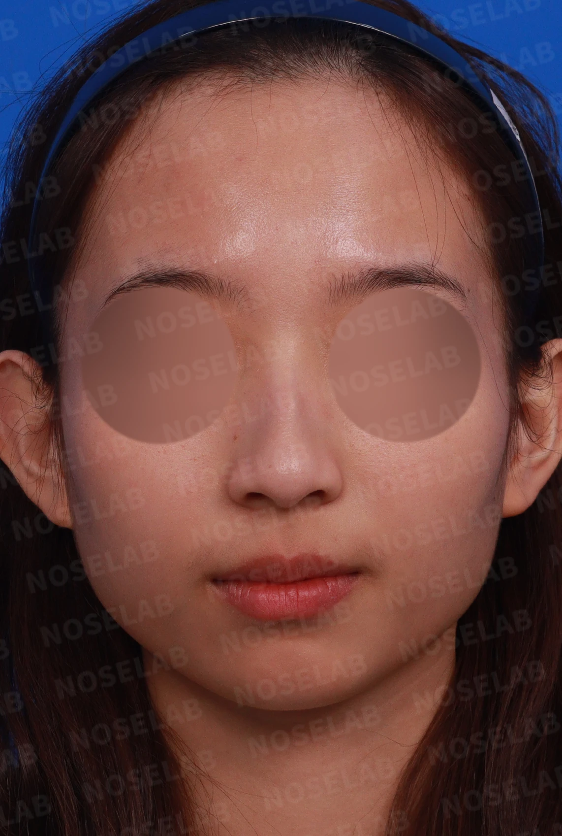 외상 뒤 심해진 매부리와 휜 코, 변화를 최소로 두는 교정 방법 — 디자인 상담 정면, 좌측 측면, 비스듬한 측면 사진